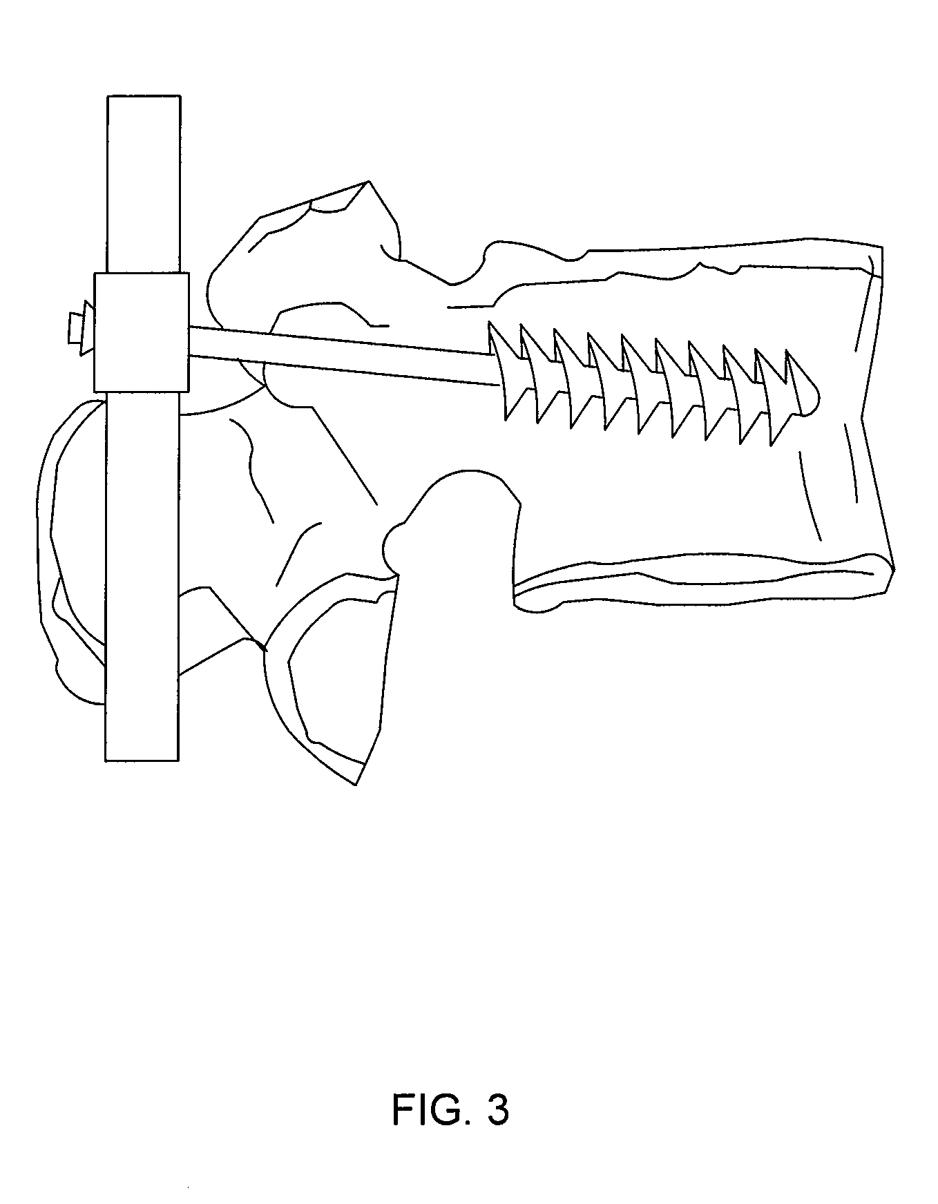 Bone screw system and method for the fixation of bone fractures