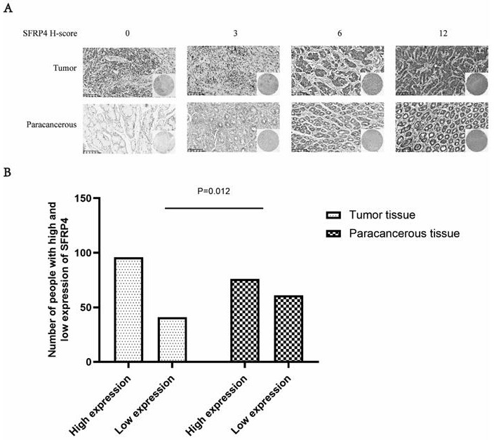 Application of SFRP4 as gastric cancer prognosis marker