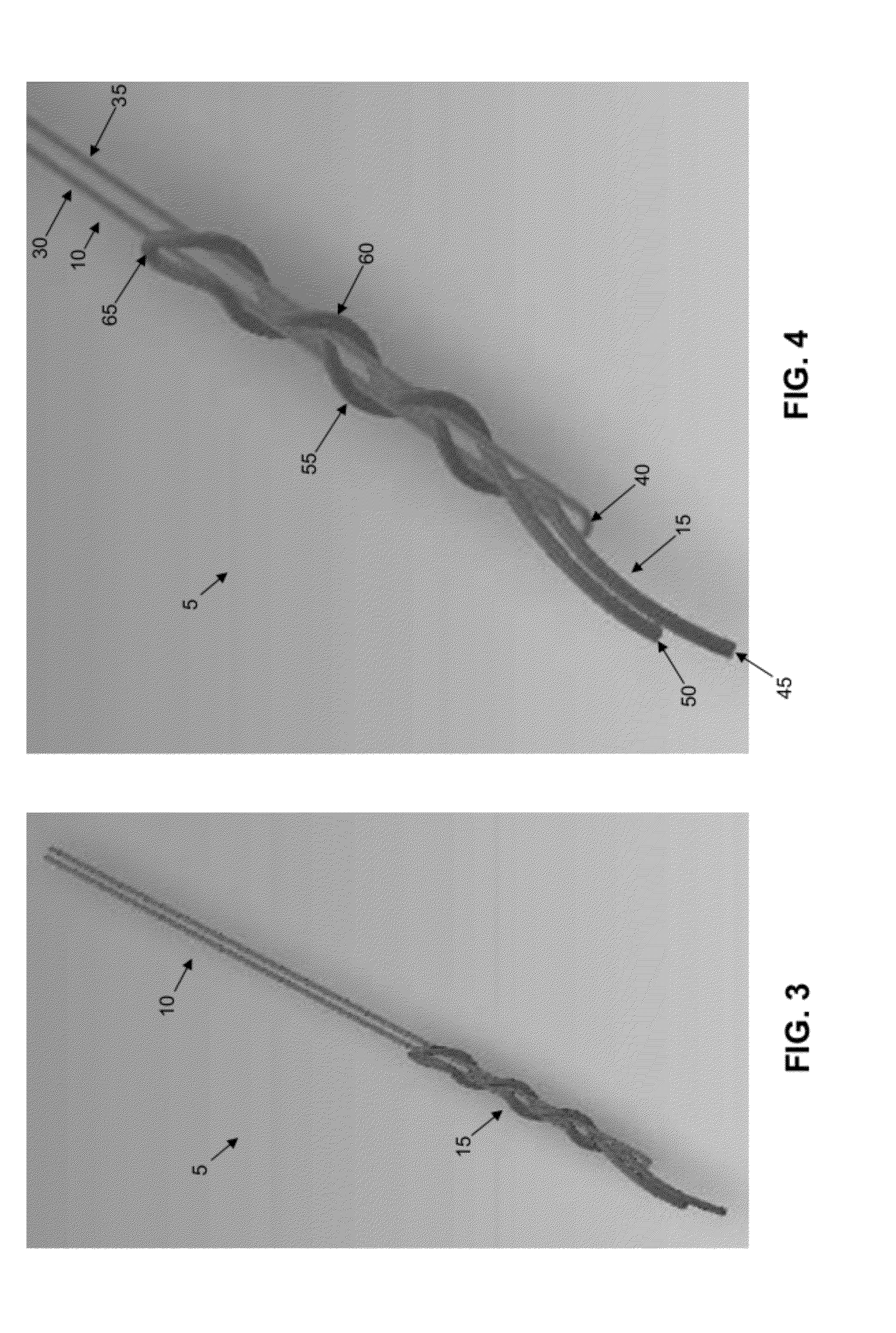 Method and apparatus for securing an object to bone, including the provision and use of a novel suture assembly for securing suture to bone