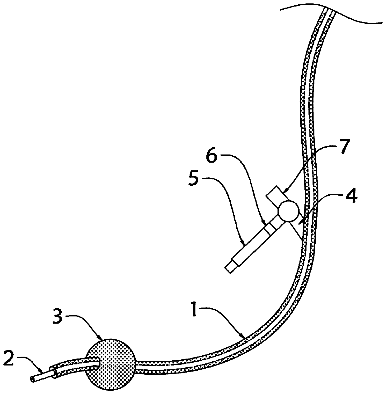 Airbag catheter