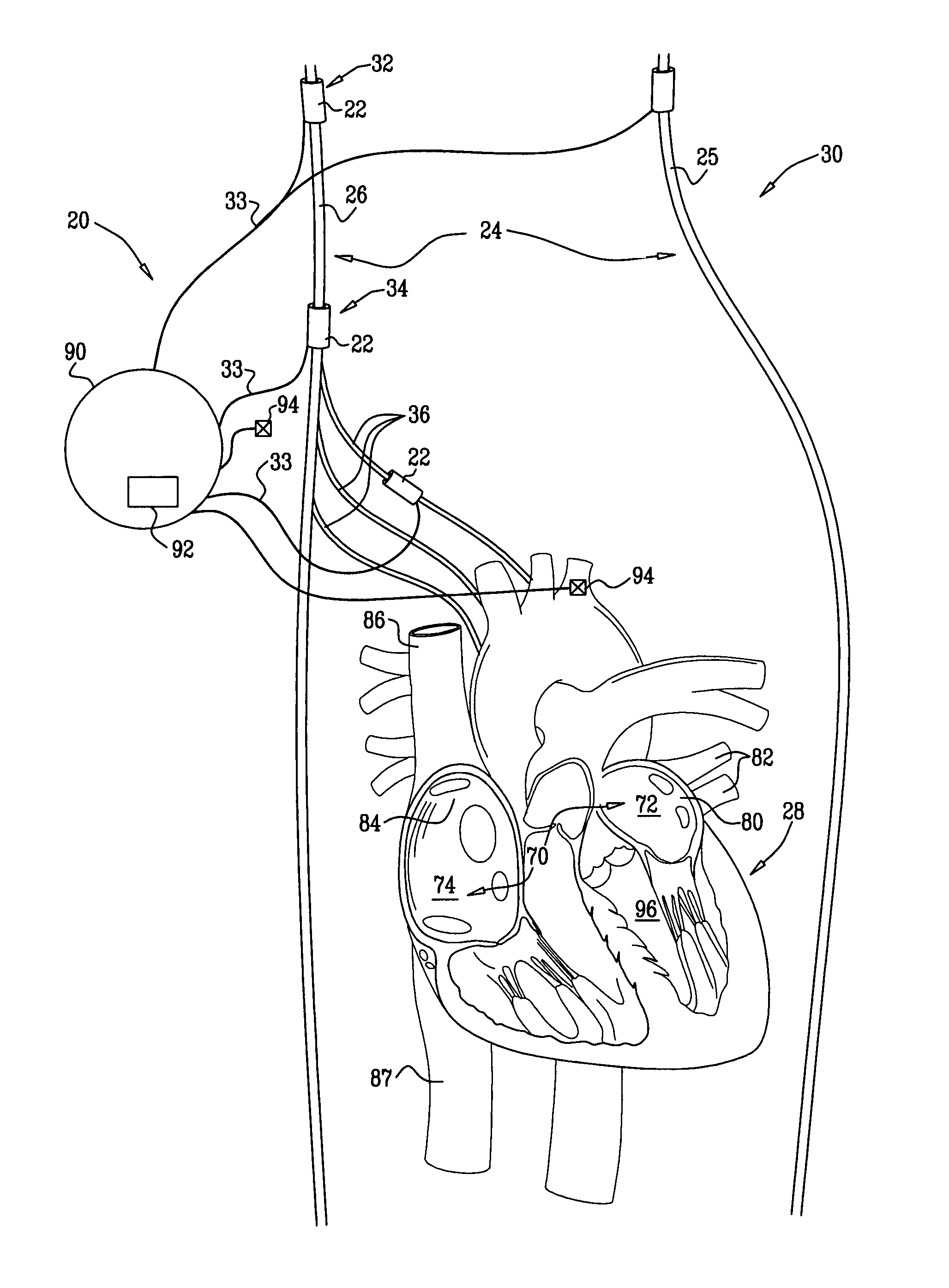 Parasympathetic stimulation for termination of non-sinus atrial tachycardia