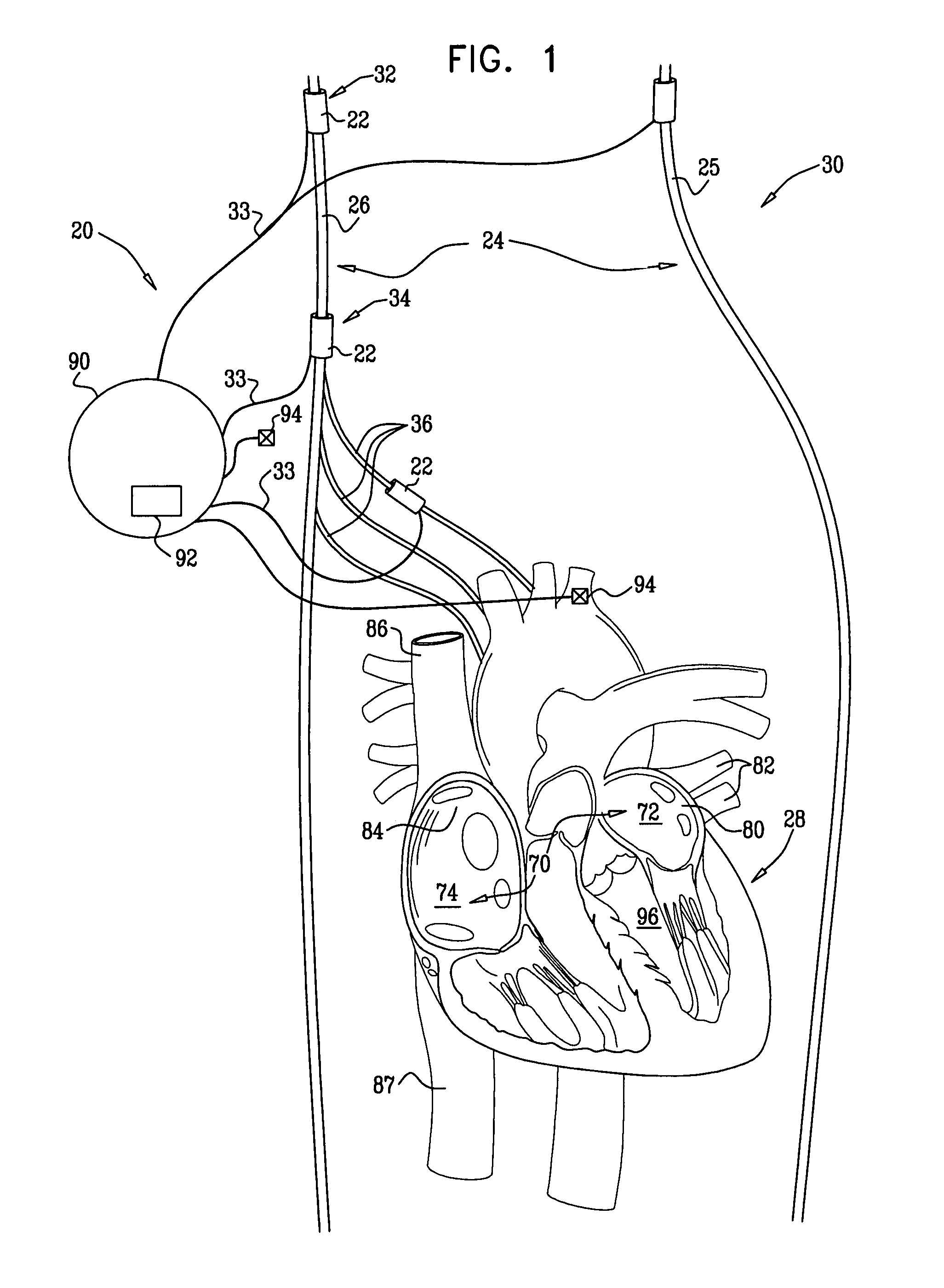 Parasympathetic stimulation for termination of non-sinus atrial tachycardia