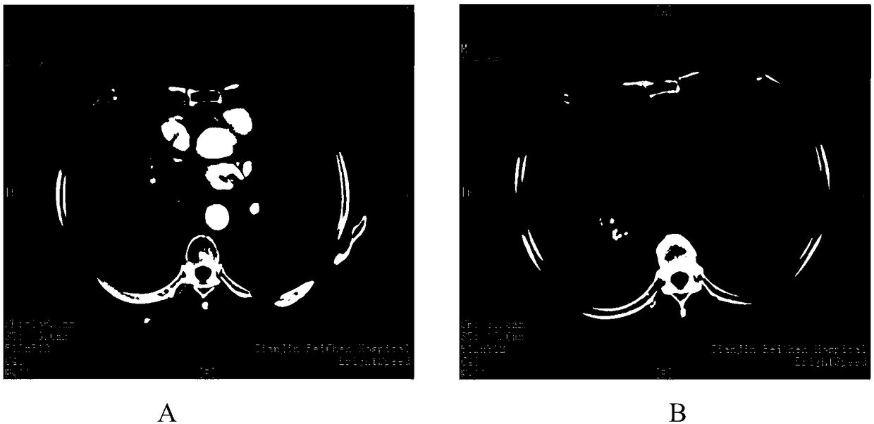 Antigen peptide chain group for treating tumor and application of antigen peptide chain group in medicine