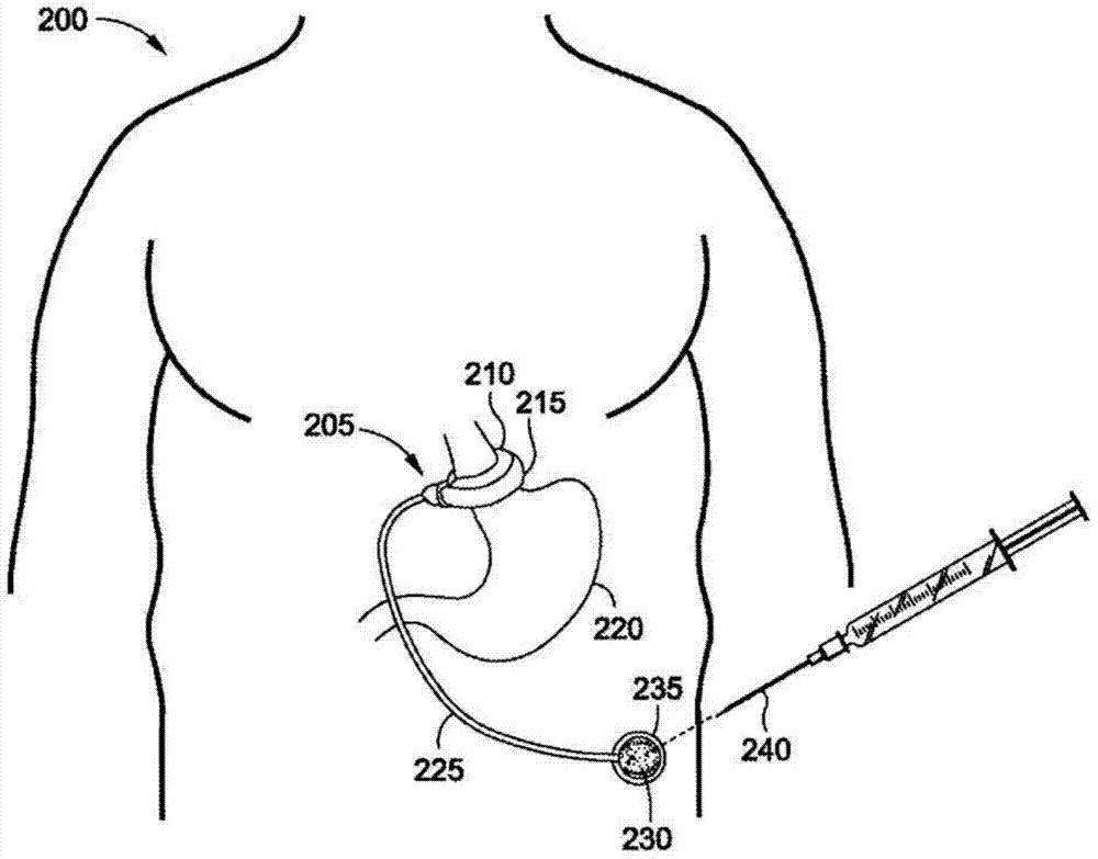 Gastric bands for reducing obstructions