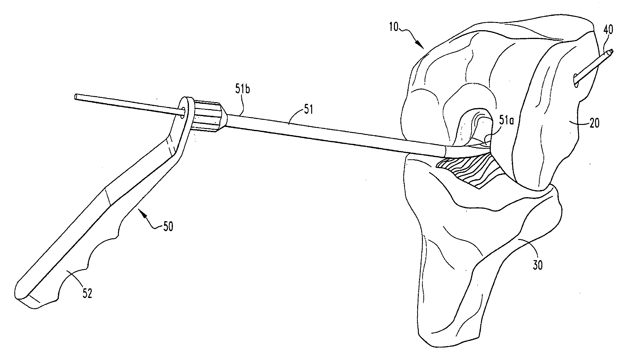 Retrodrill System