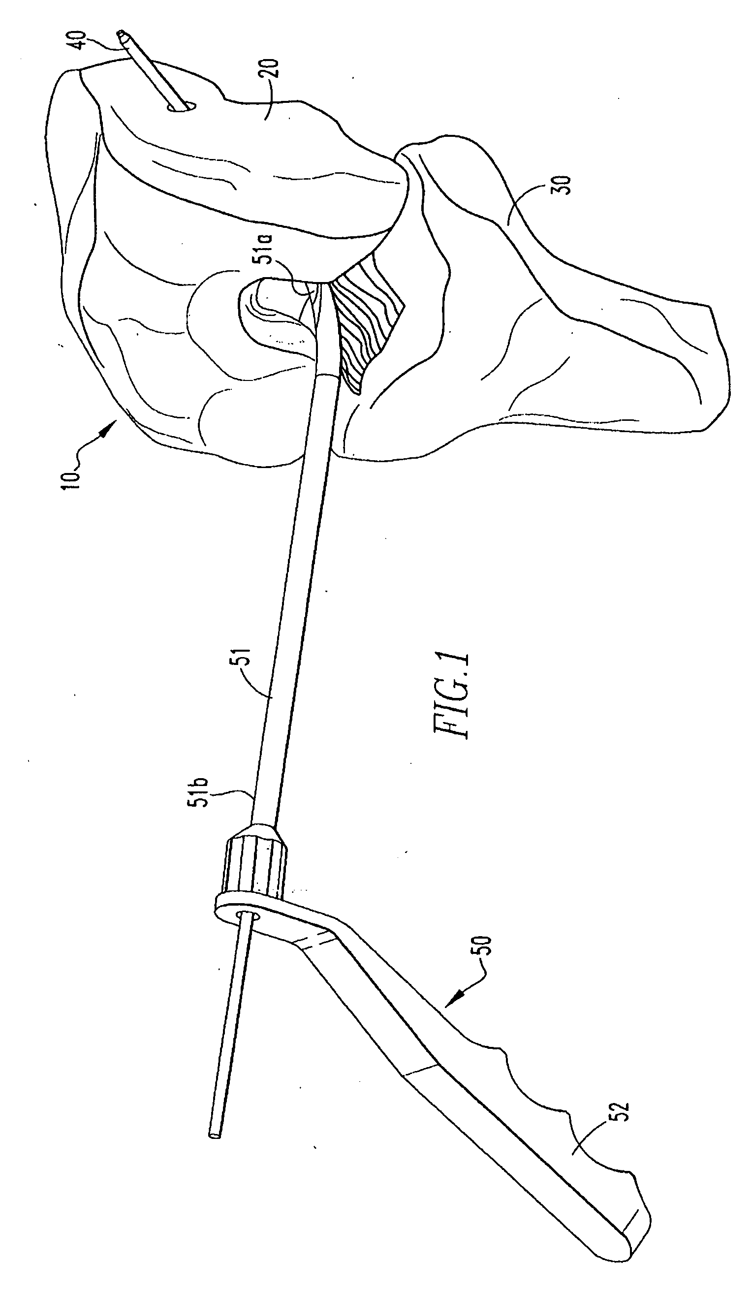 Retrodrill System