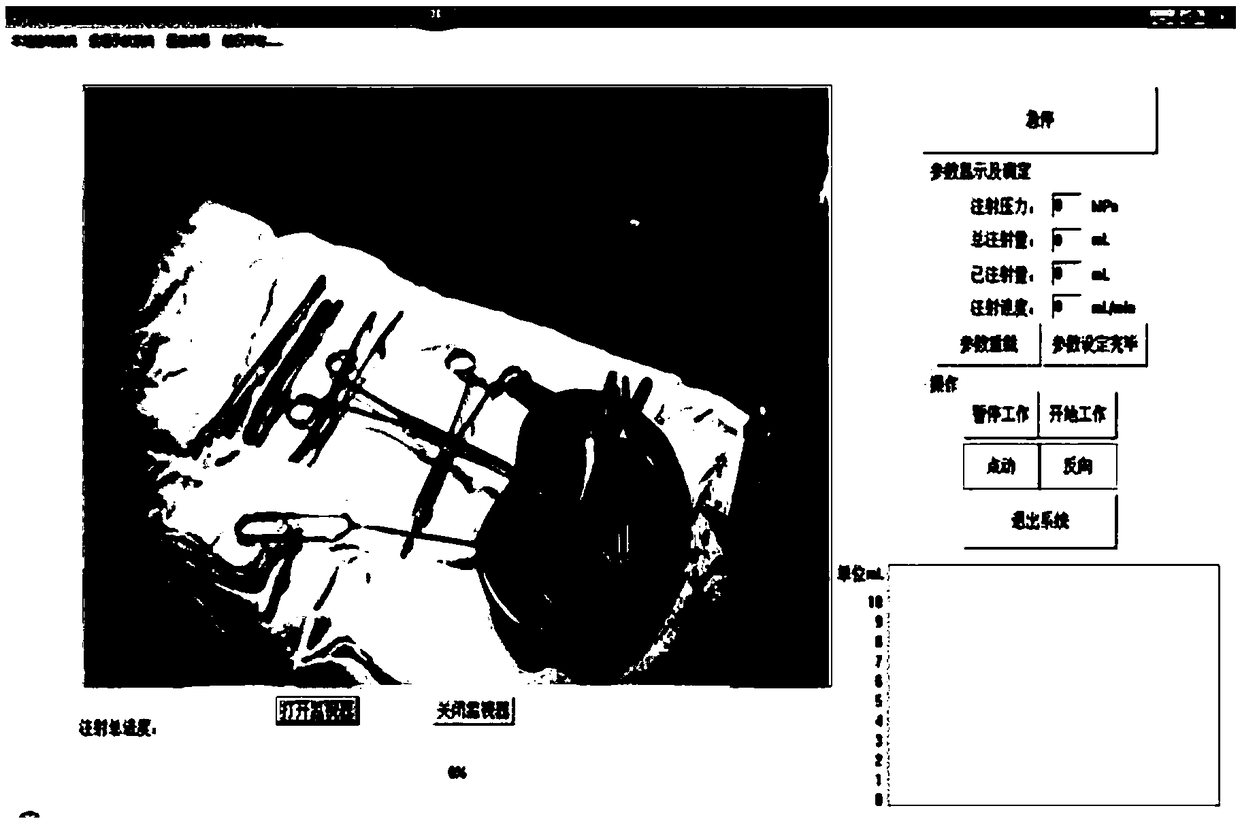 Remotely controlled bone cement injection system