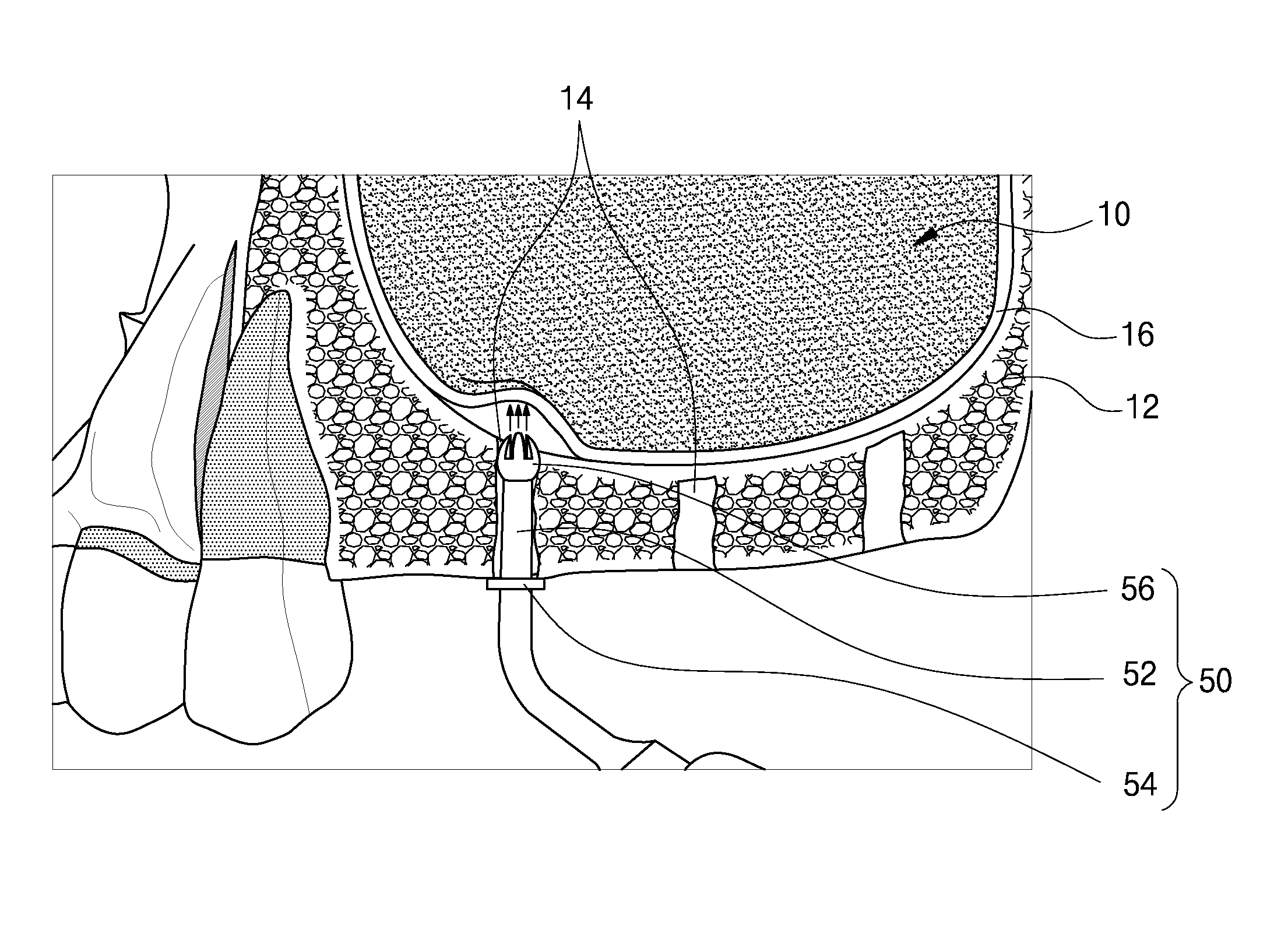 Method of maxillary sinus bone grafting for placement of implant