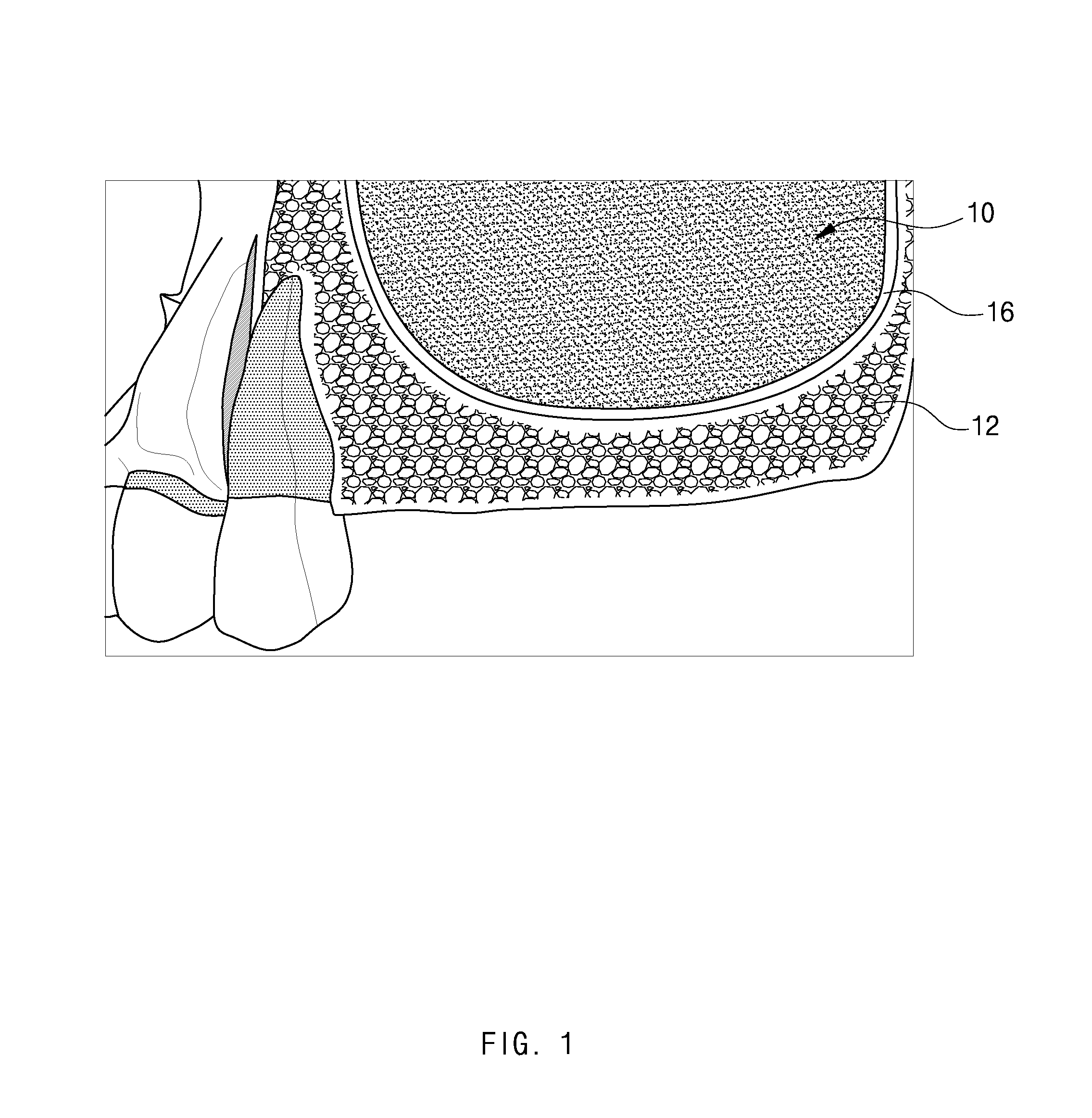 Method of maxillary sinus bone grafting for placement of implant