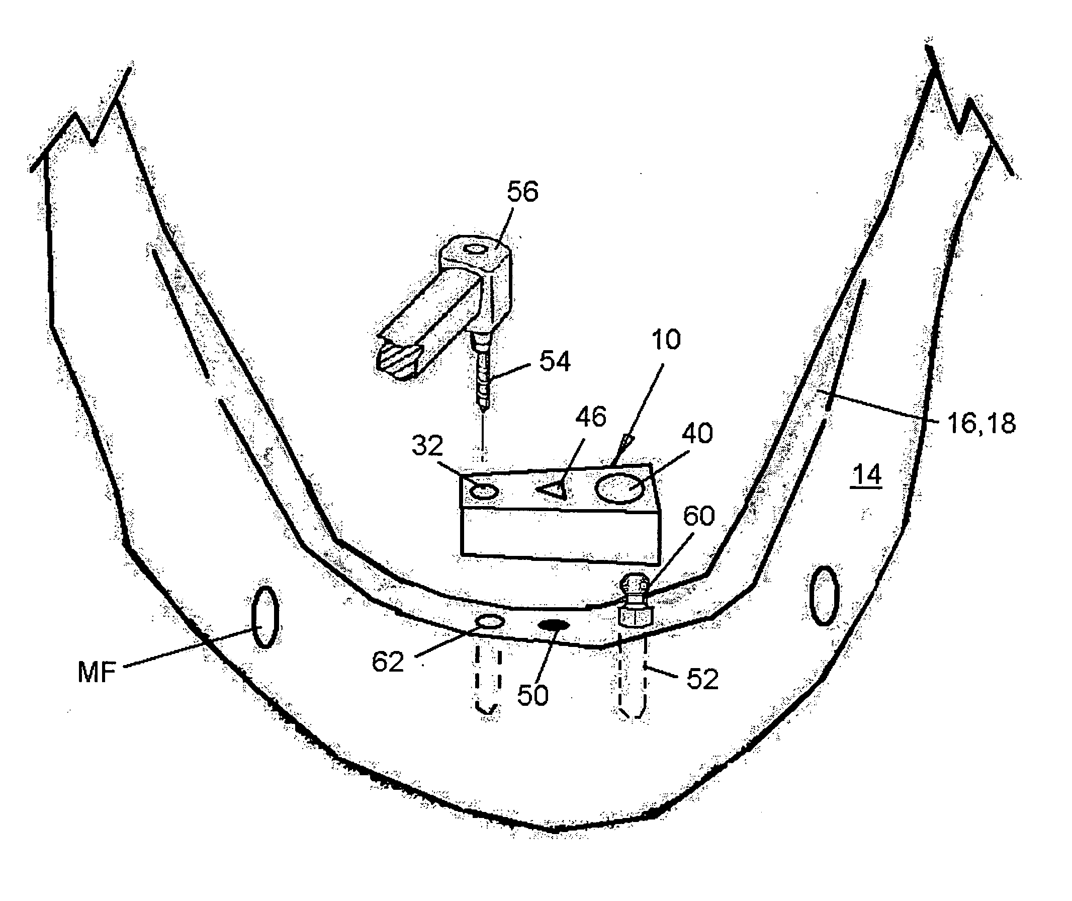 Hole guide for mini and standard dental implants