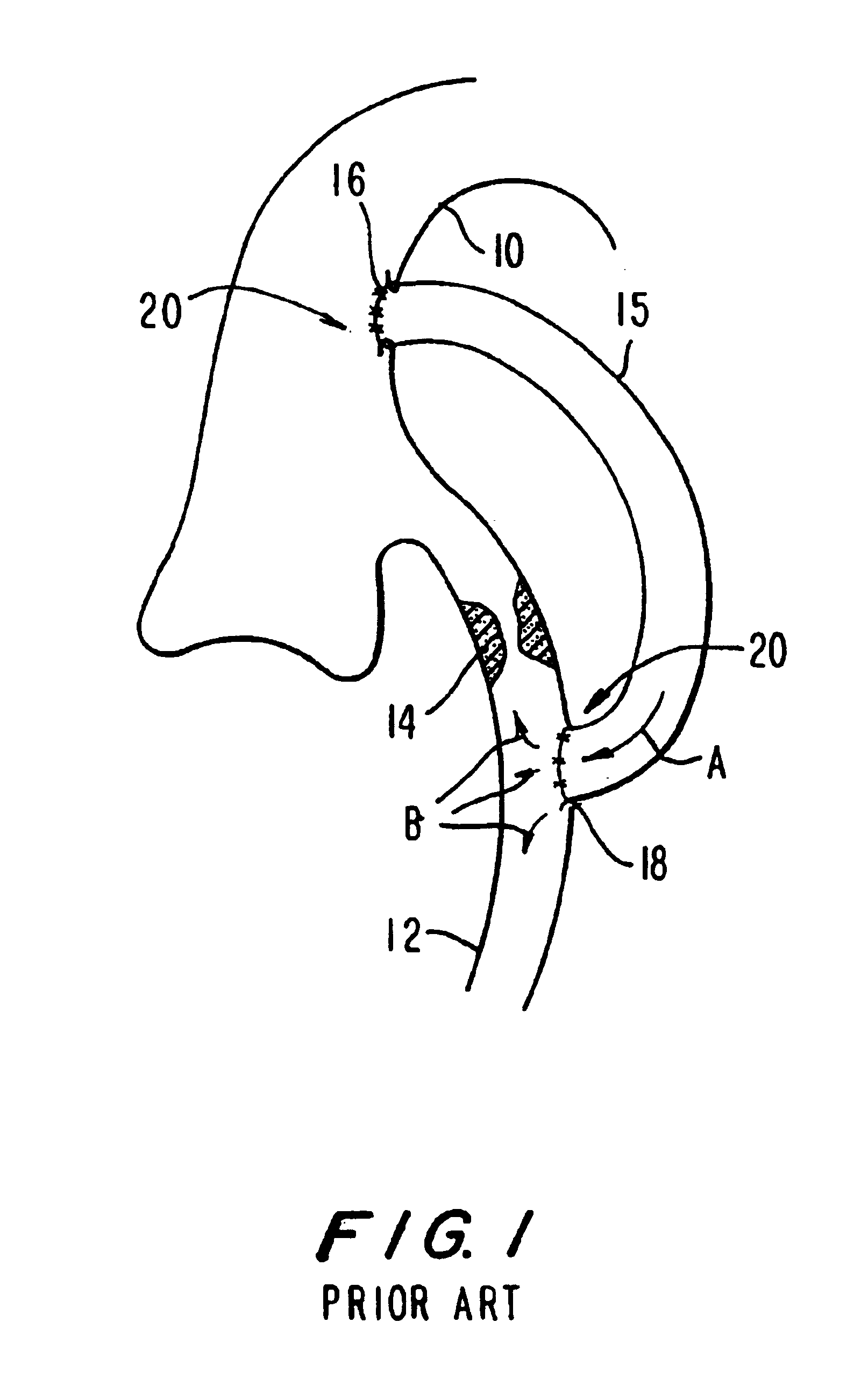 Medical grafting methods and apparatus