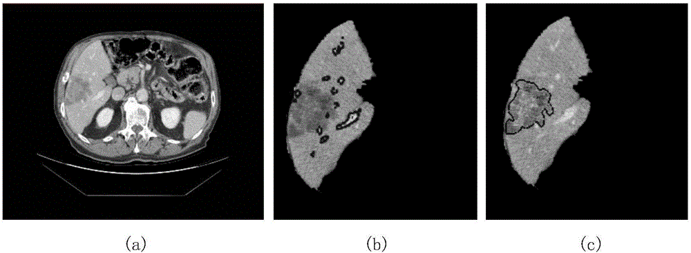 Three-way-decision-based liver tumor CT image classification method