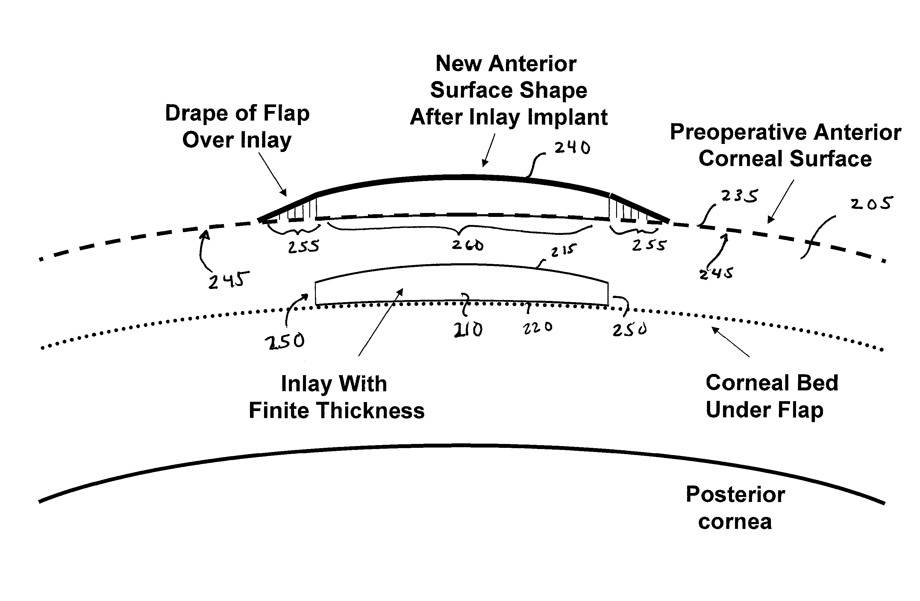 Method of using small diameter intracorneal inlays to treat visual impairment