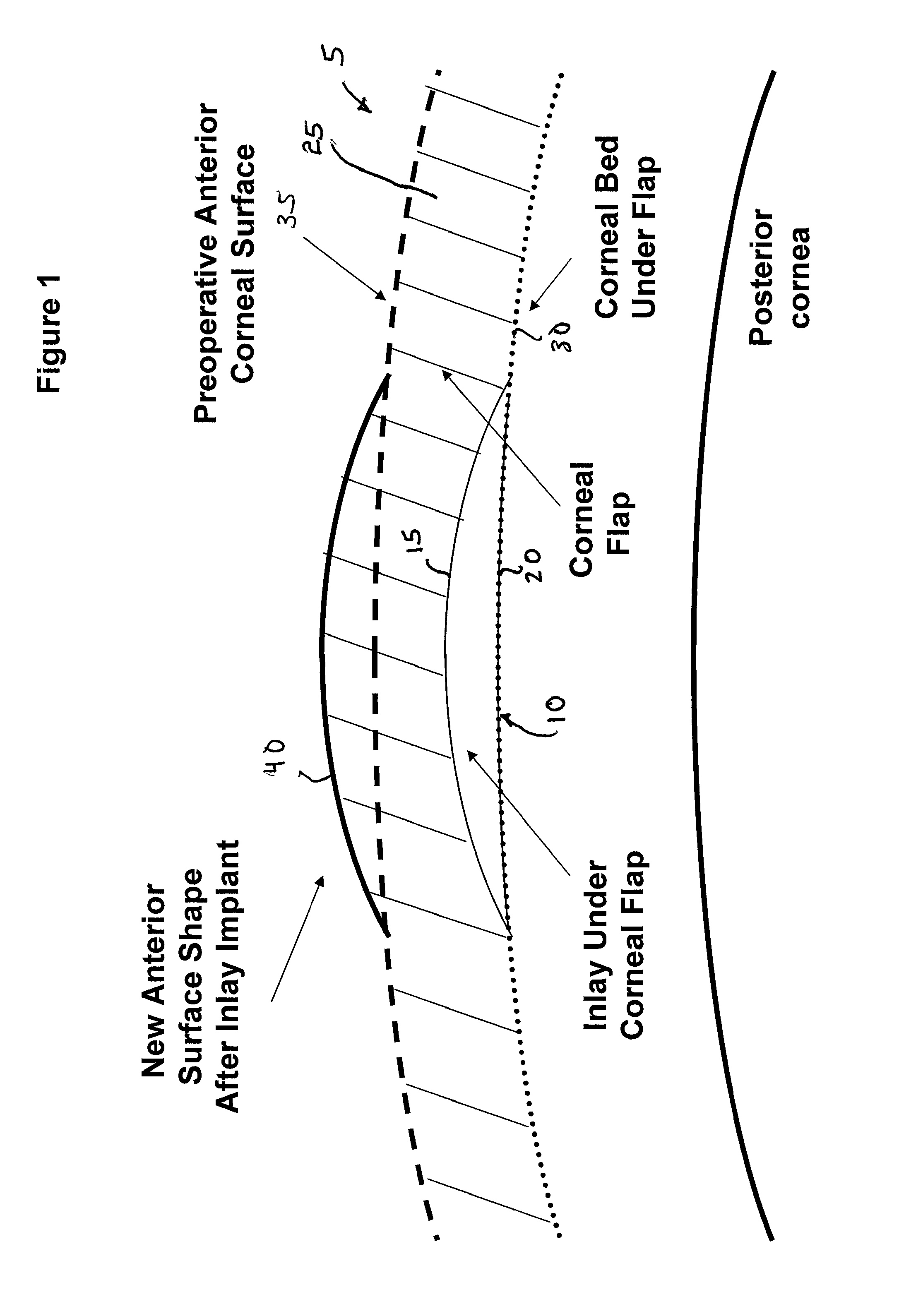 Method of using small diameter intracorneal inlays to treat visual impairment