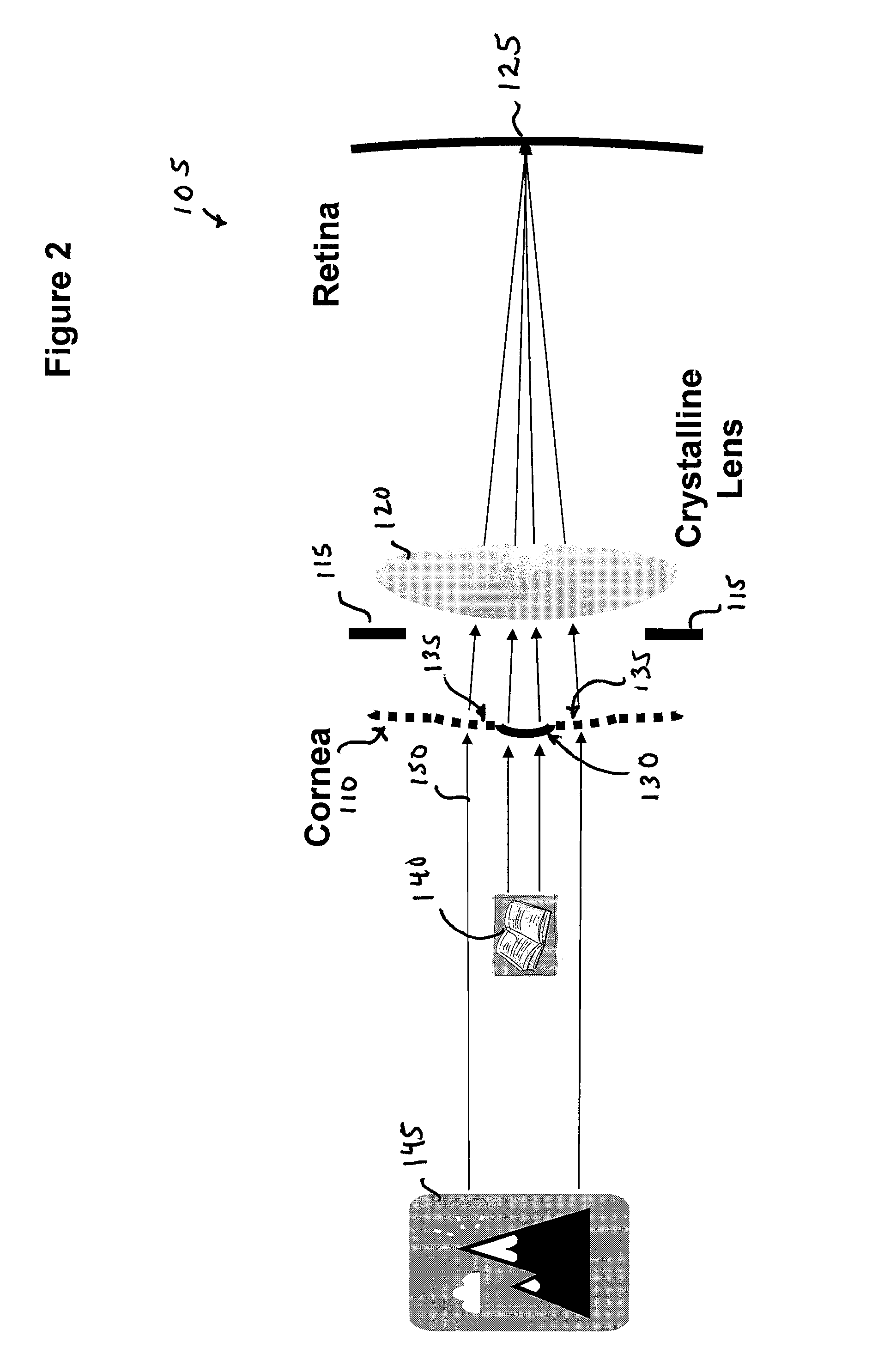 Method of using small diameter intracorneal inlays to treat visual impairment