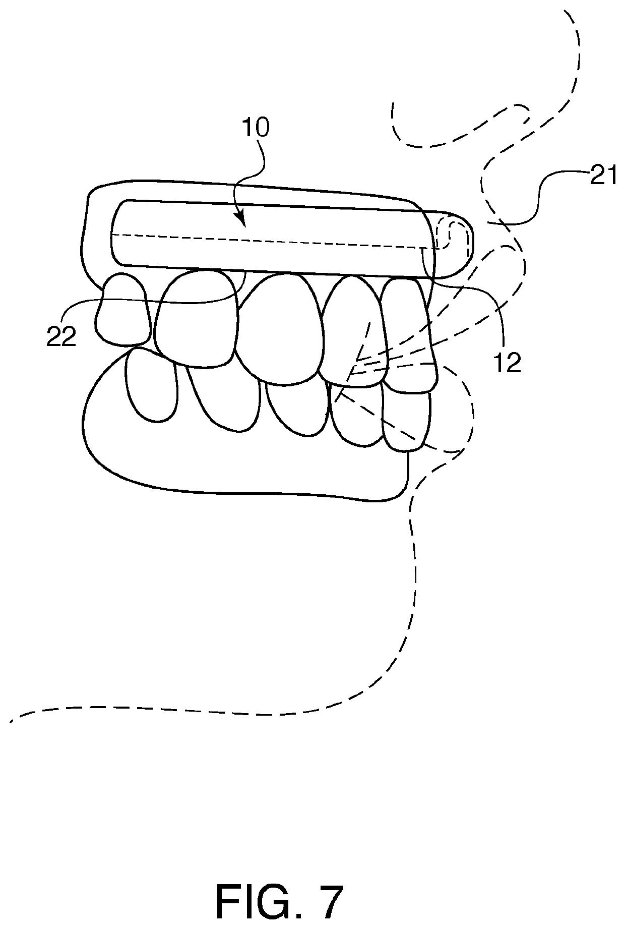 Lip enhancement device