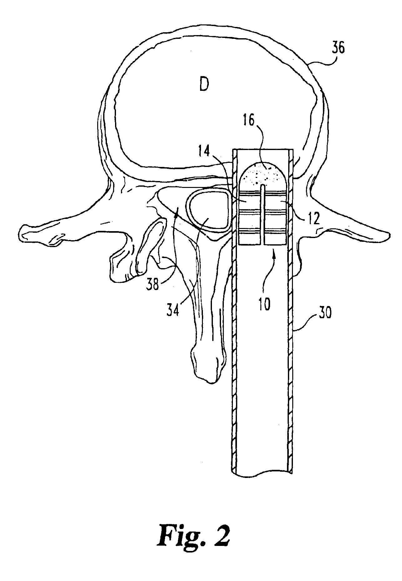 Flexible implant using partially demineralized bone