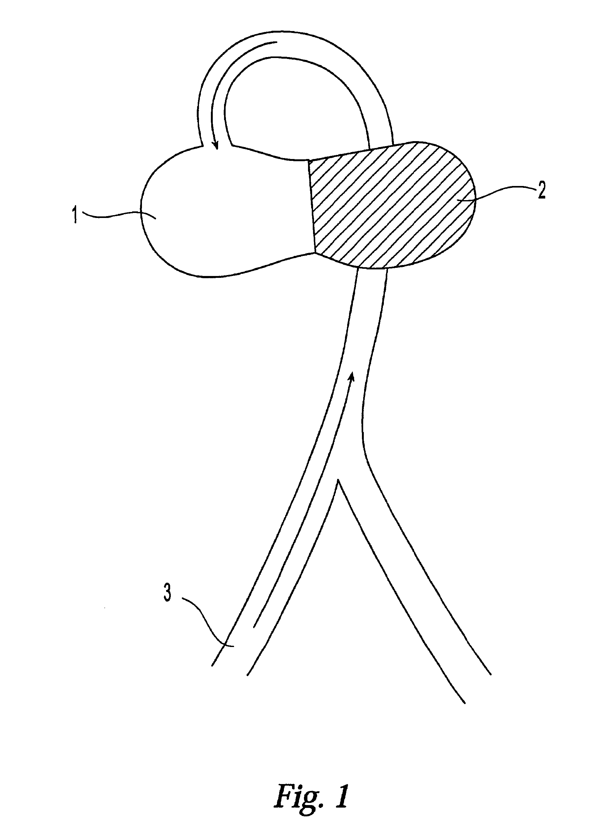 Modification of properties and geometry of heart tissue to influence function