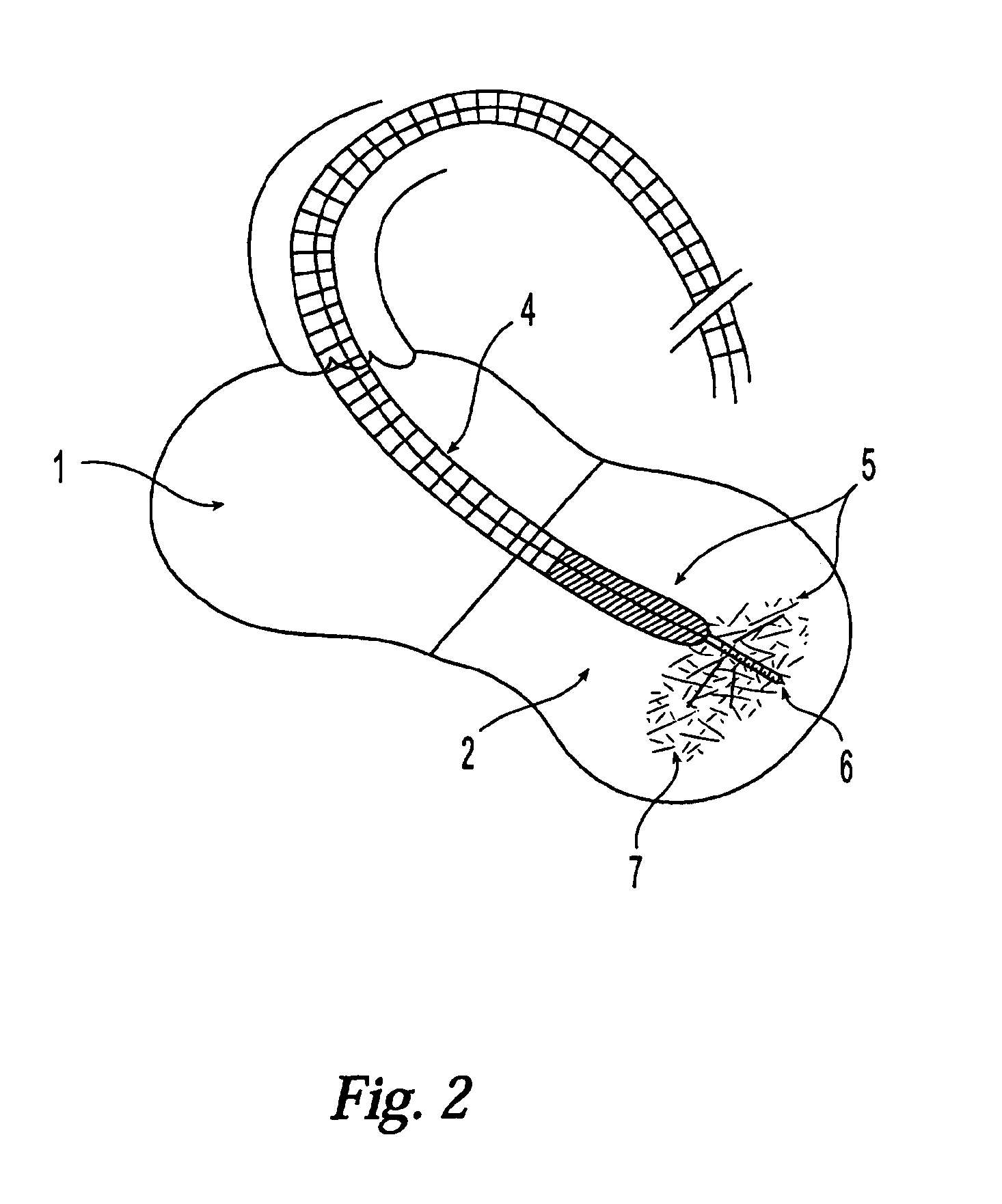 Modification of properties and geometry of heart tissue to influence function