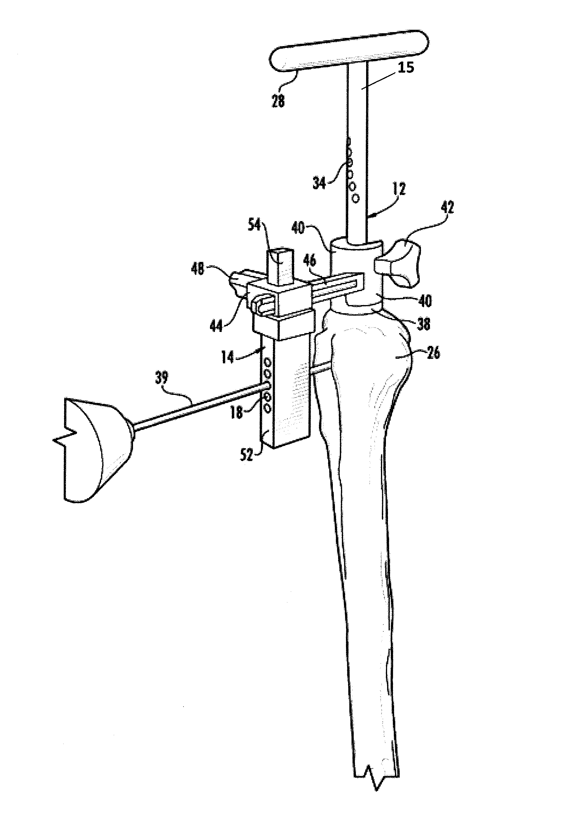 System for treating proximal humeral fractures and method of using the same