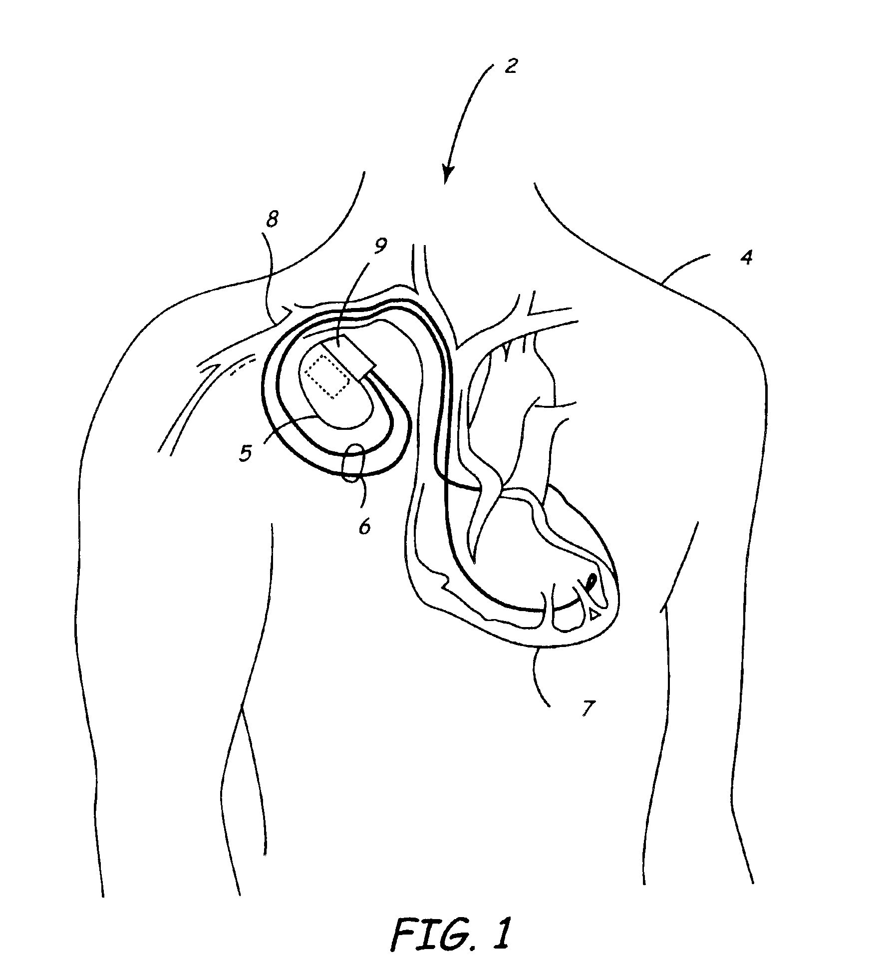 Medical electrical lead connector arrangement including anti-rotation means