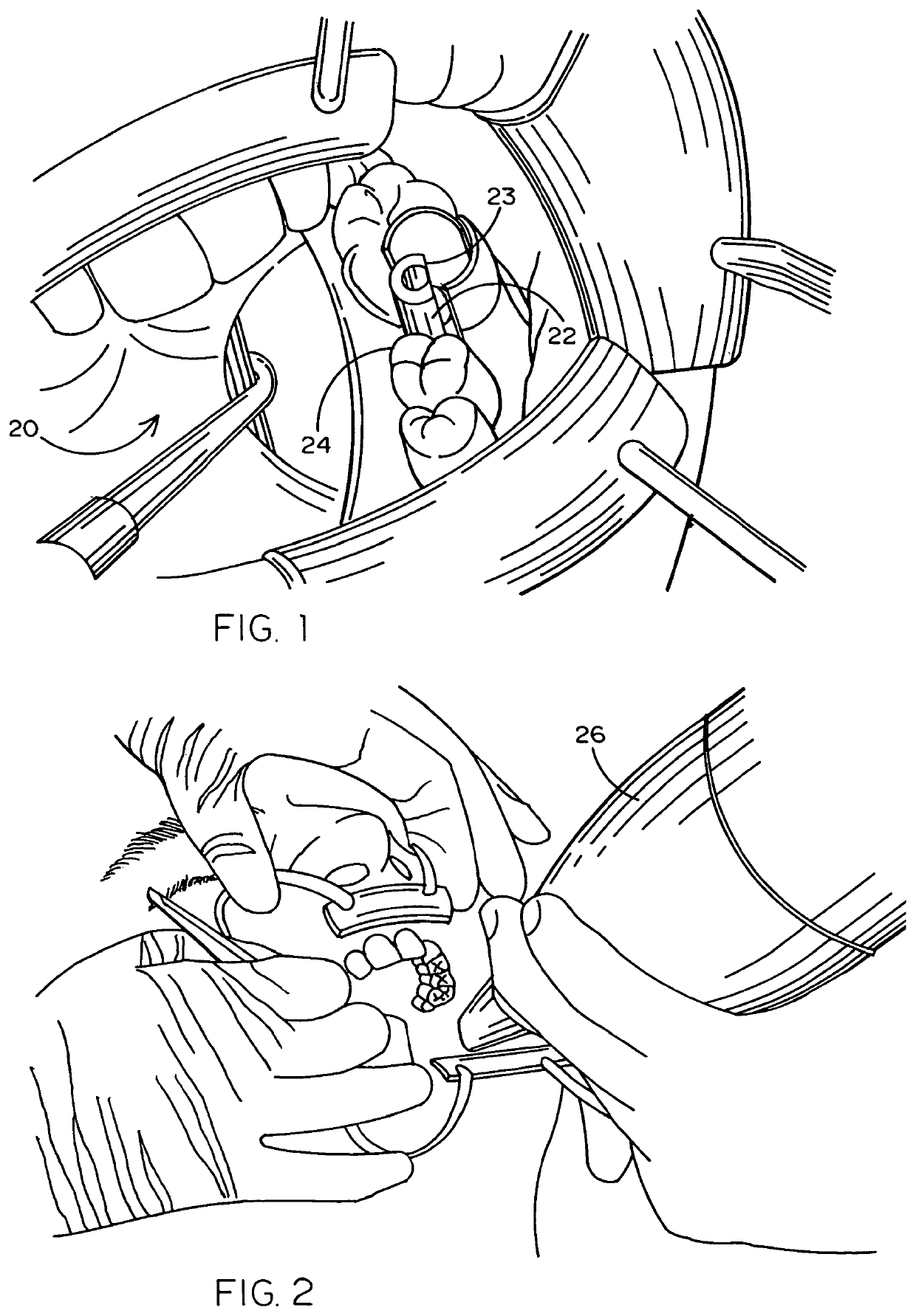 Method of designing and fabricating patient-specific restorations from intra-oral scanning of a digital impression coping