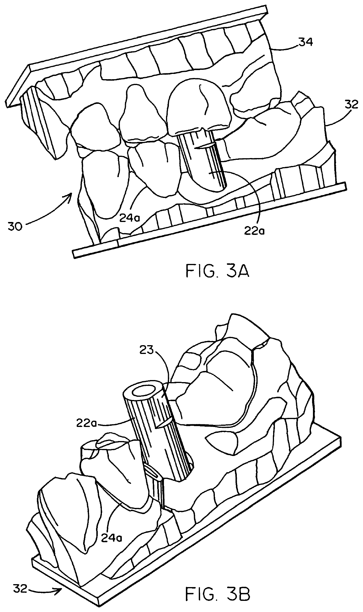 Method of designing and fabricating patient-specific restorations from intra-oral scanning of a digital impression coping