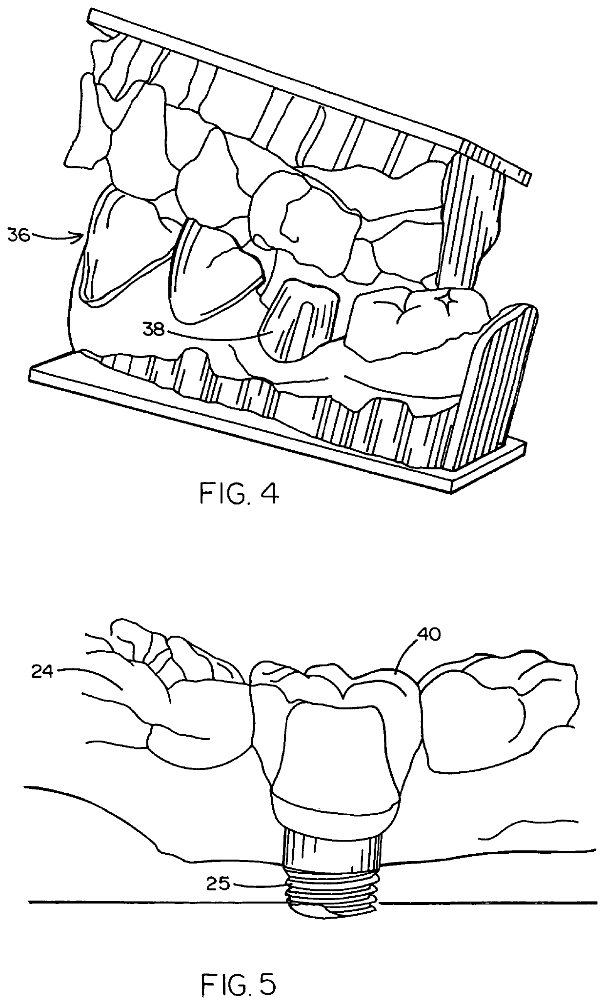 Method of designing and fabricating patient-specific restorations from intra-oral scanning of a digital impression coping