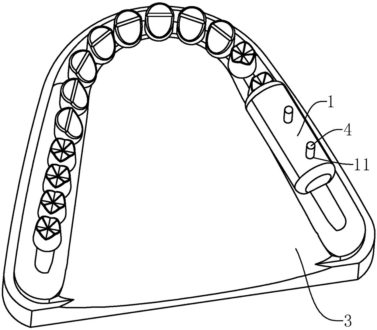 Dental implant implantation method