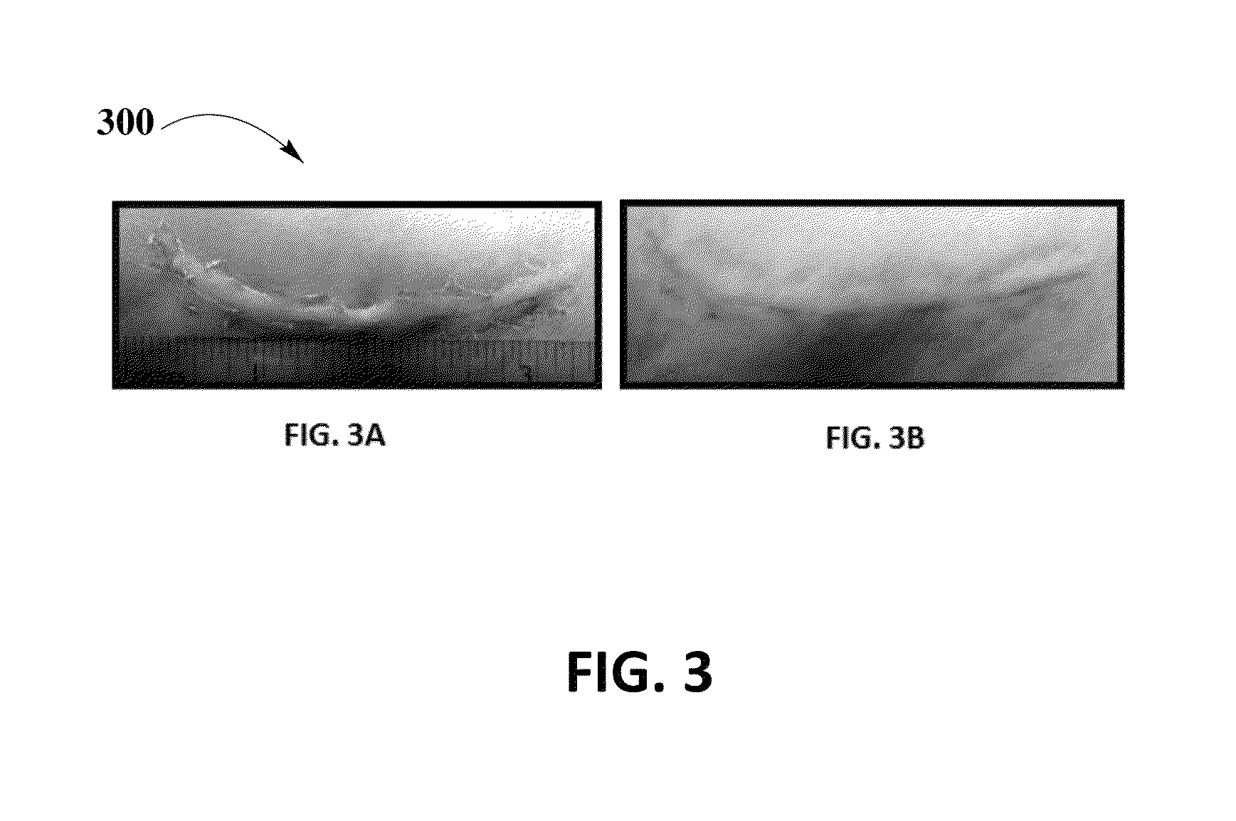 Mixture of betamethasone and tranilast with a transdermal gel for scar treatment