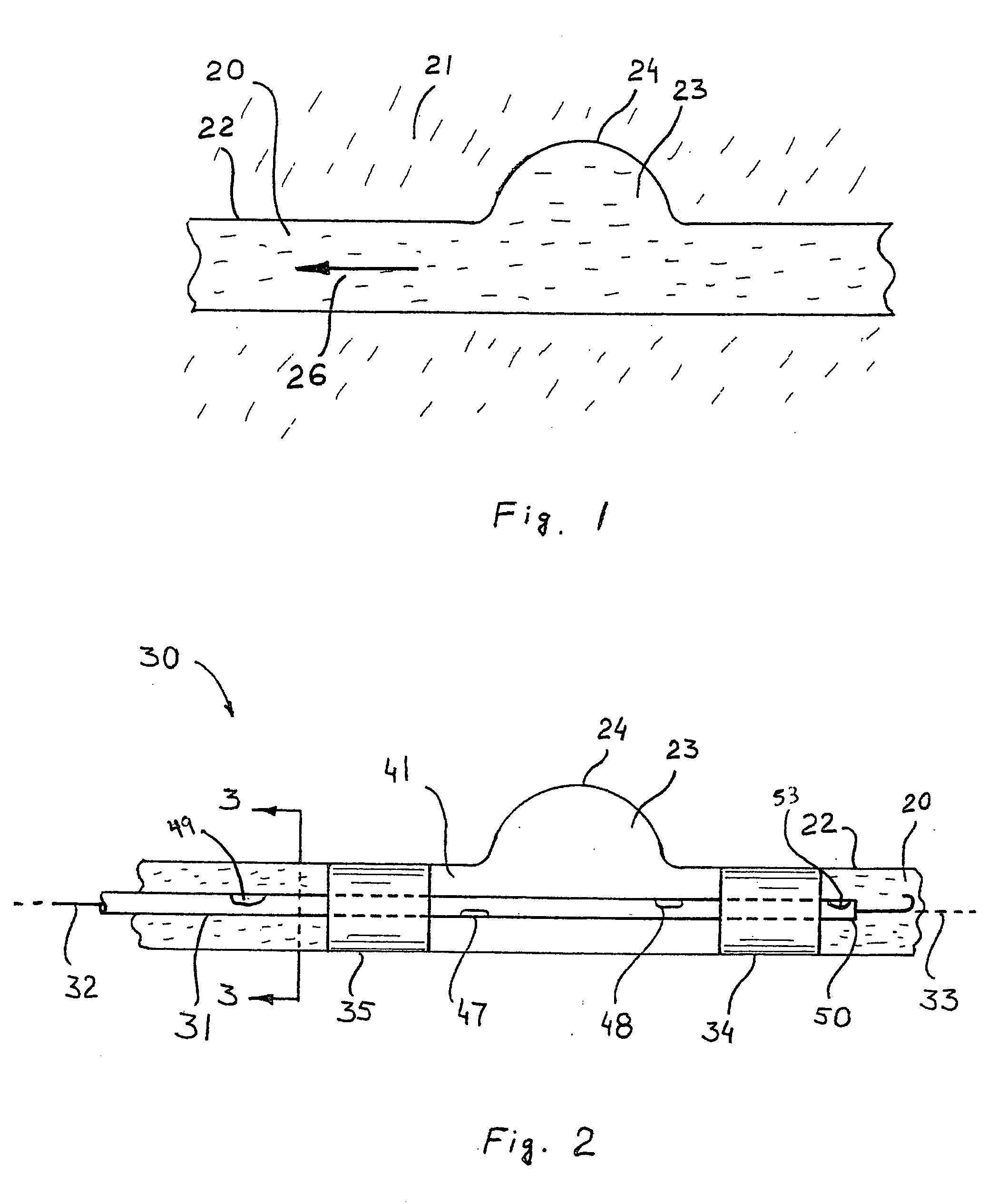 Method and apparatus for treating aneurysms