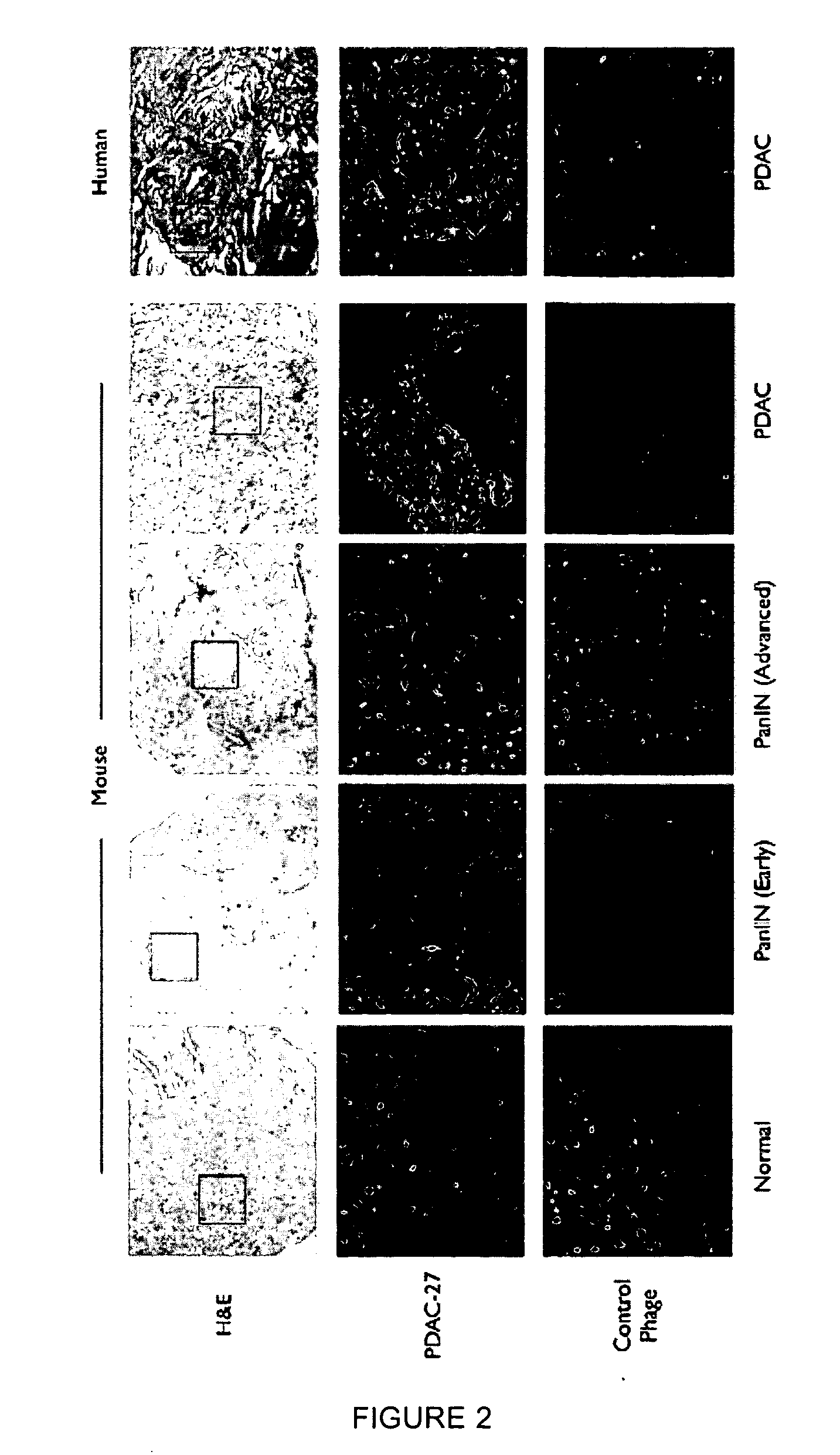 Plectin-1 targeted agents for detection and treatment of pancreatic ductal adenocarcinoma