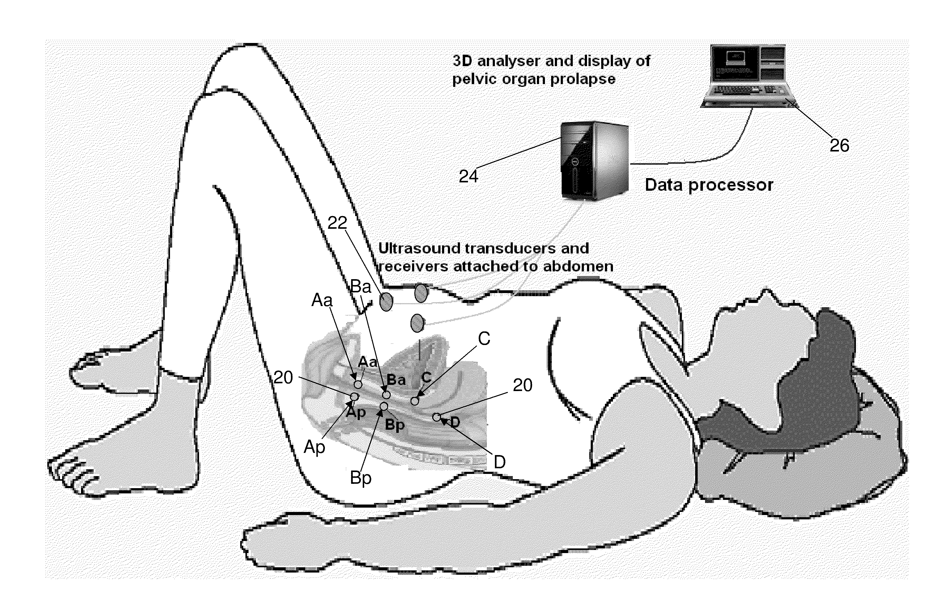 Electronic pelvic organ prolapse quantification system