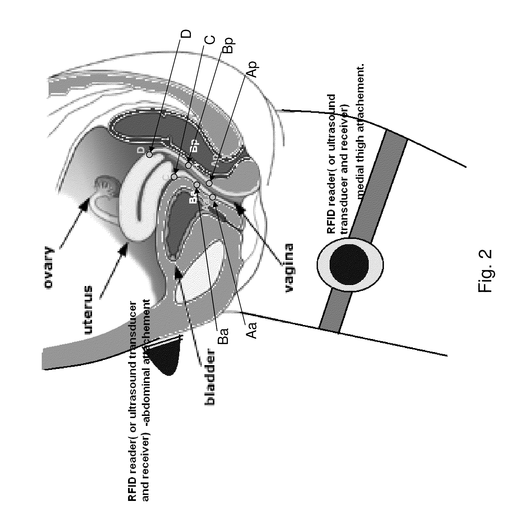 Electronic pelvic organ prolapse quantification system