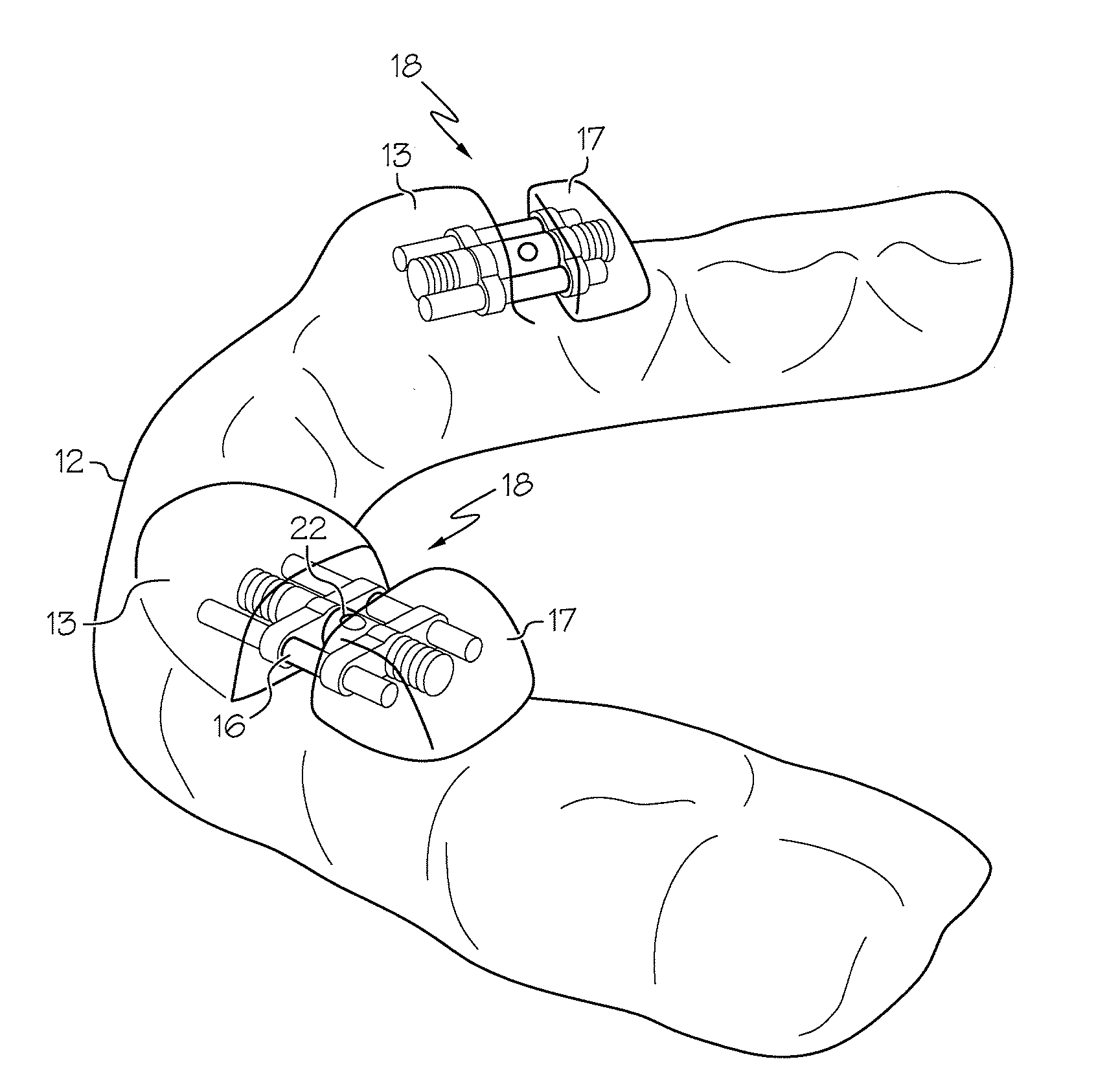 Intraoral apparatus for managing snoring and obstructive sleep apnea