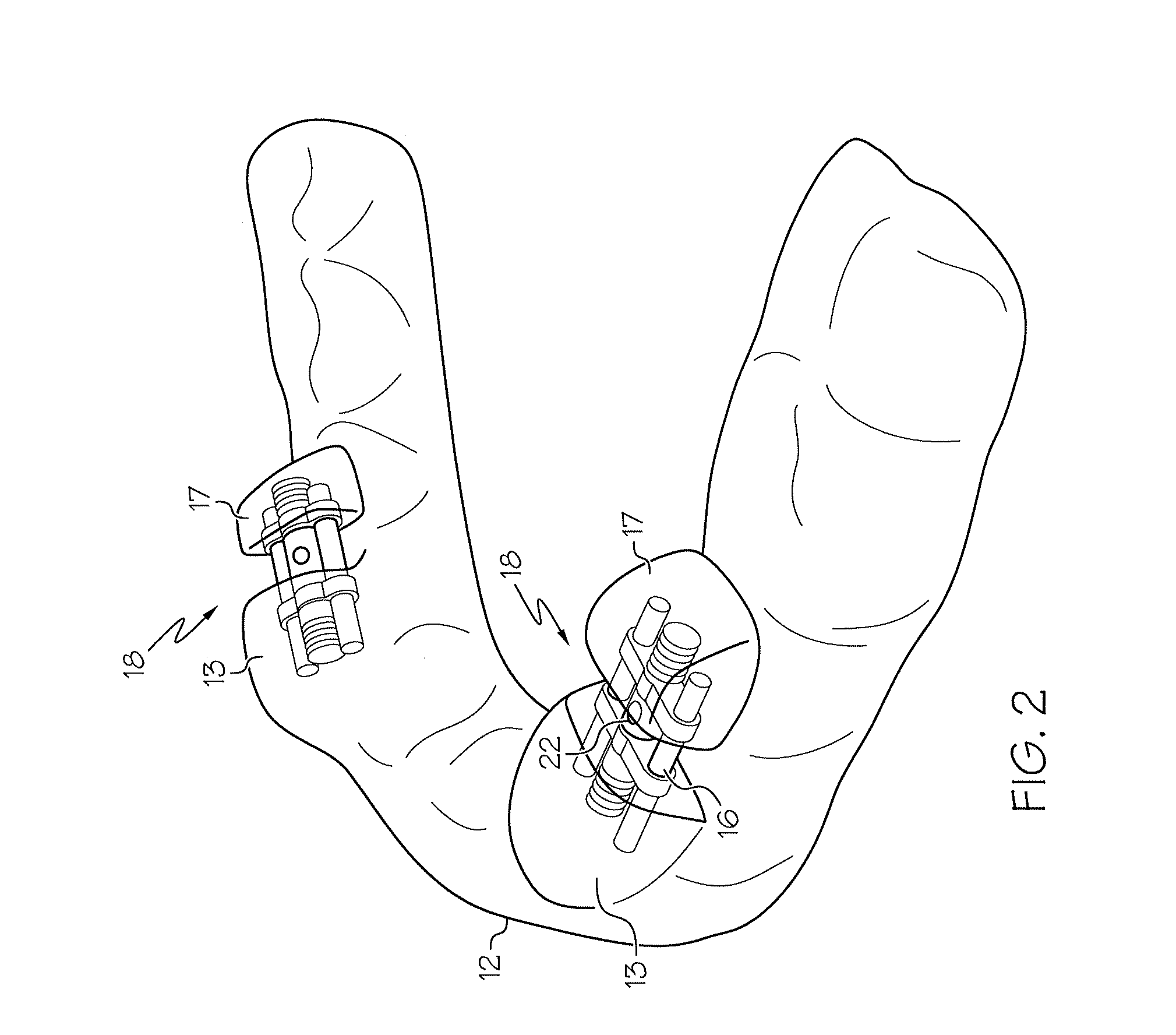 Intraoral apparatus for managing snoring and obstructive sleep apnea