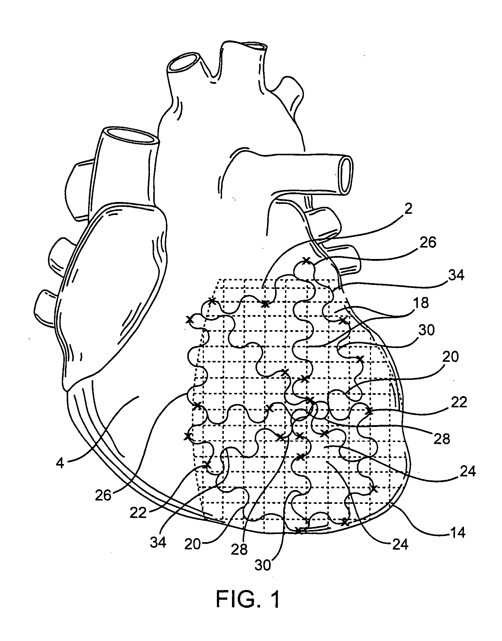 Heart support to prevent ventricular remodeling