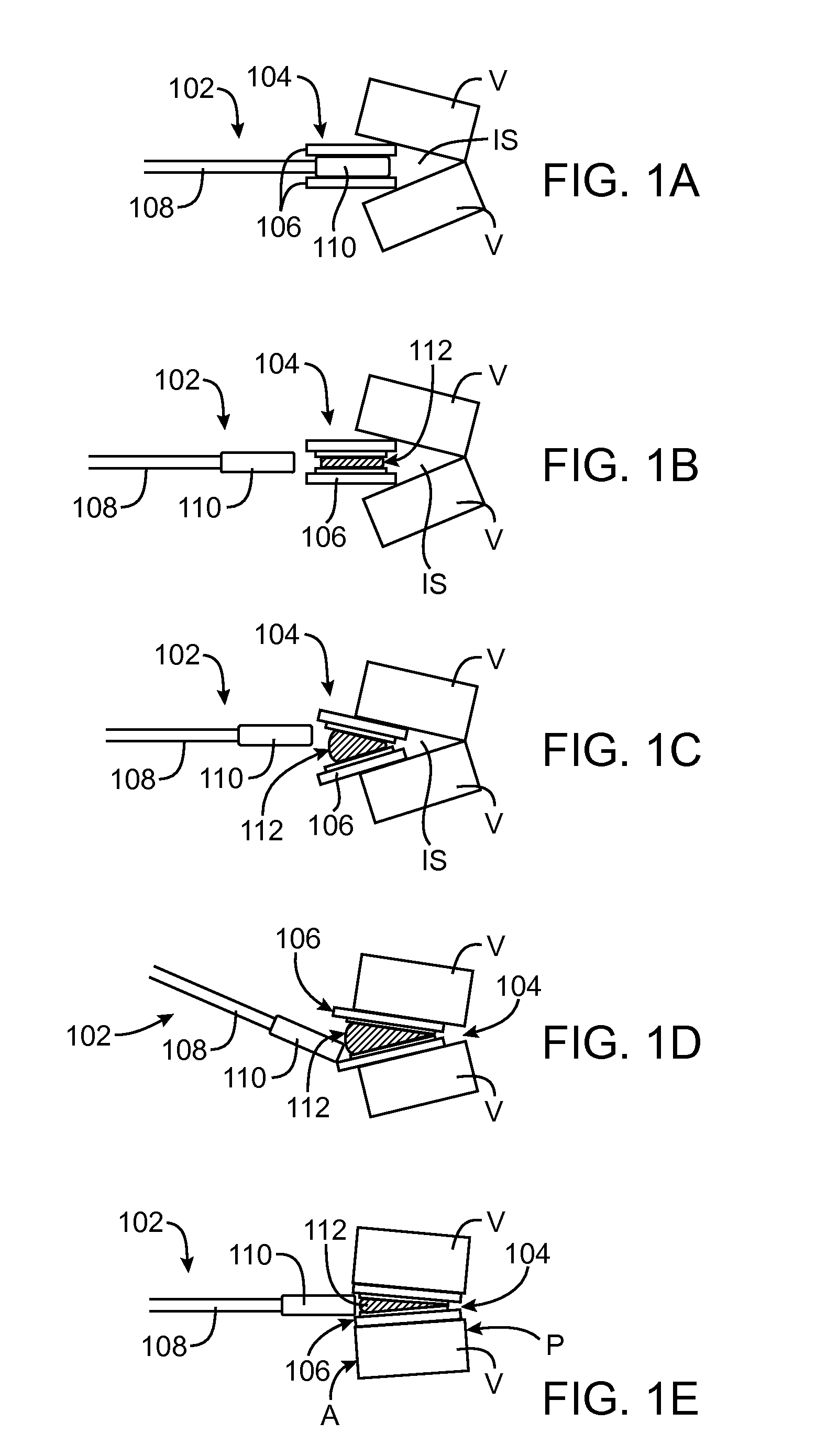 Methods and Apparatus for Intervertebral Disc Prosthesis Insertion