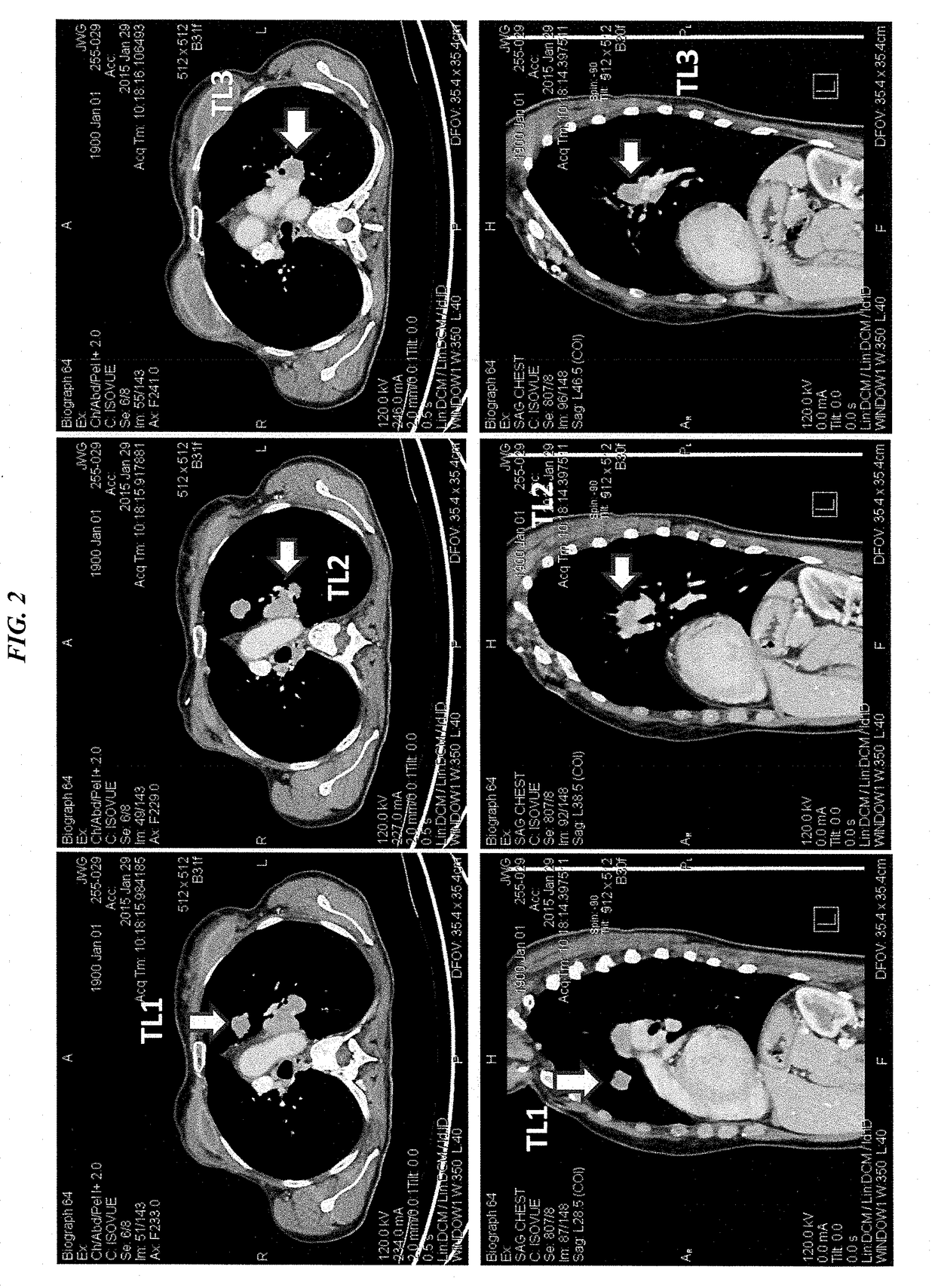 Efficacy of Anti-trop-2-sn-38 antibody drug conjugates for therapy of tumors relapsed/refractory to checkpoint inhibitors