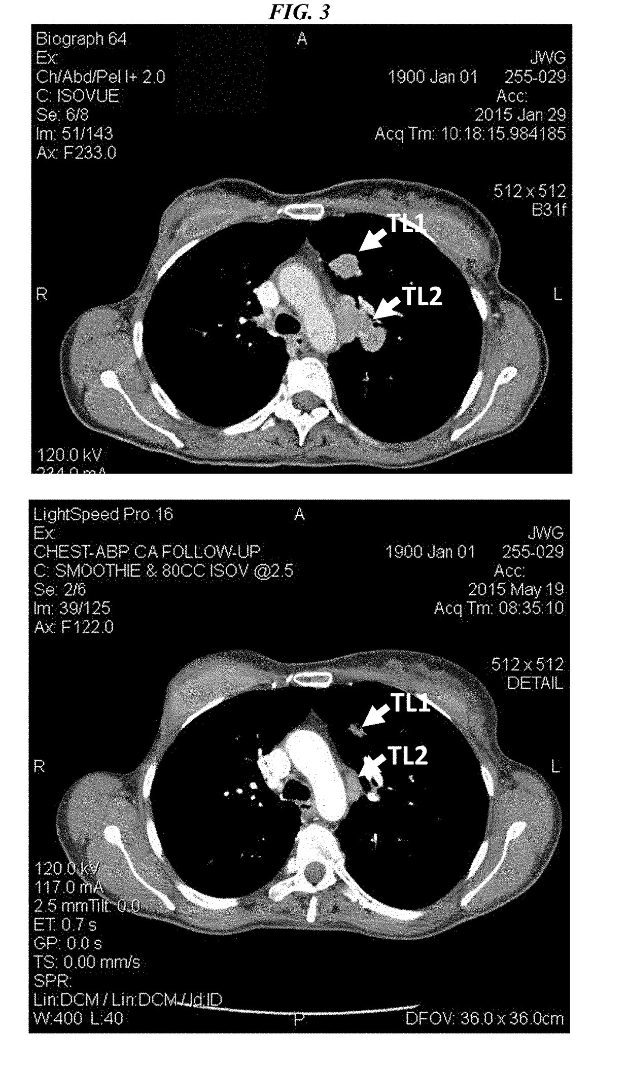 Efficacy of Anti-trop-2-sn-38 antibody drug conjugates for therapy of tumors relapsed/refractory to checkpoint inhibitors