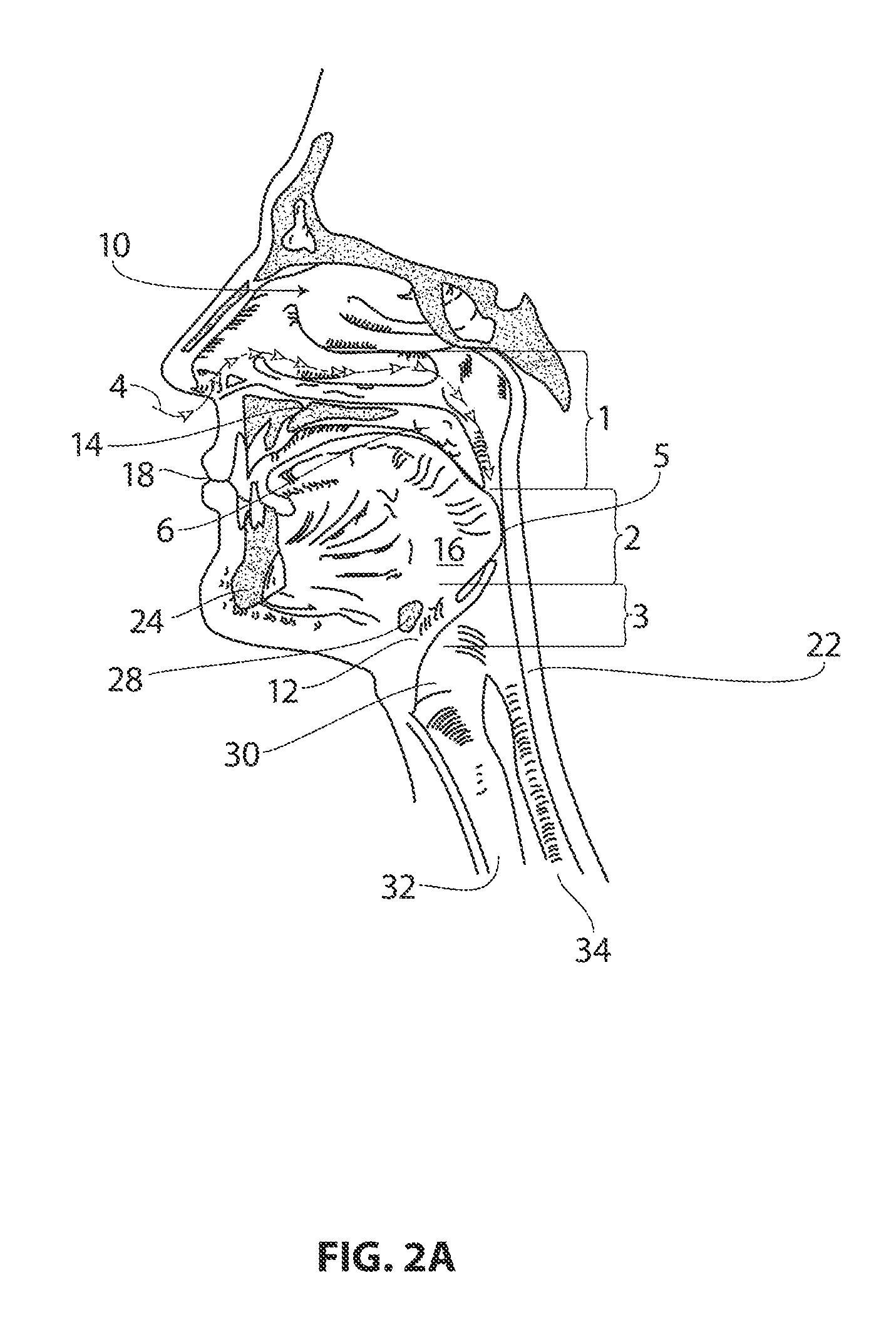 Systems and methods for treatment of sleep apnea