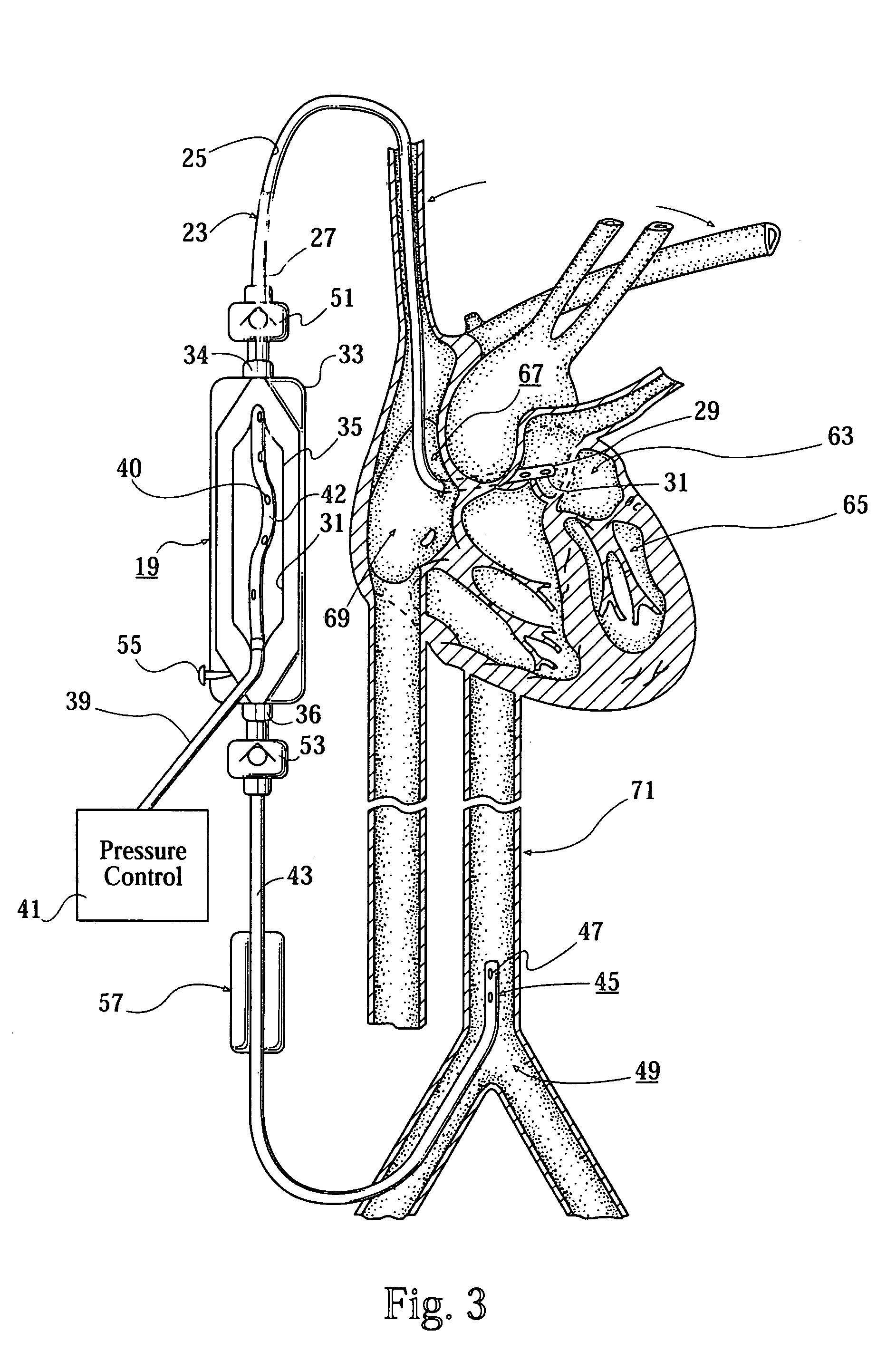 Minimally invasive ventricular assist technology and method