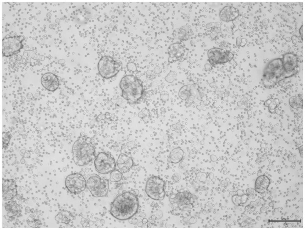 Culture medium for culturing primary cells related to cholecystic cholangiocarcinoma