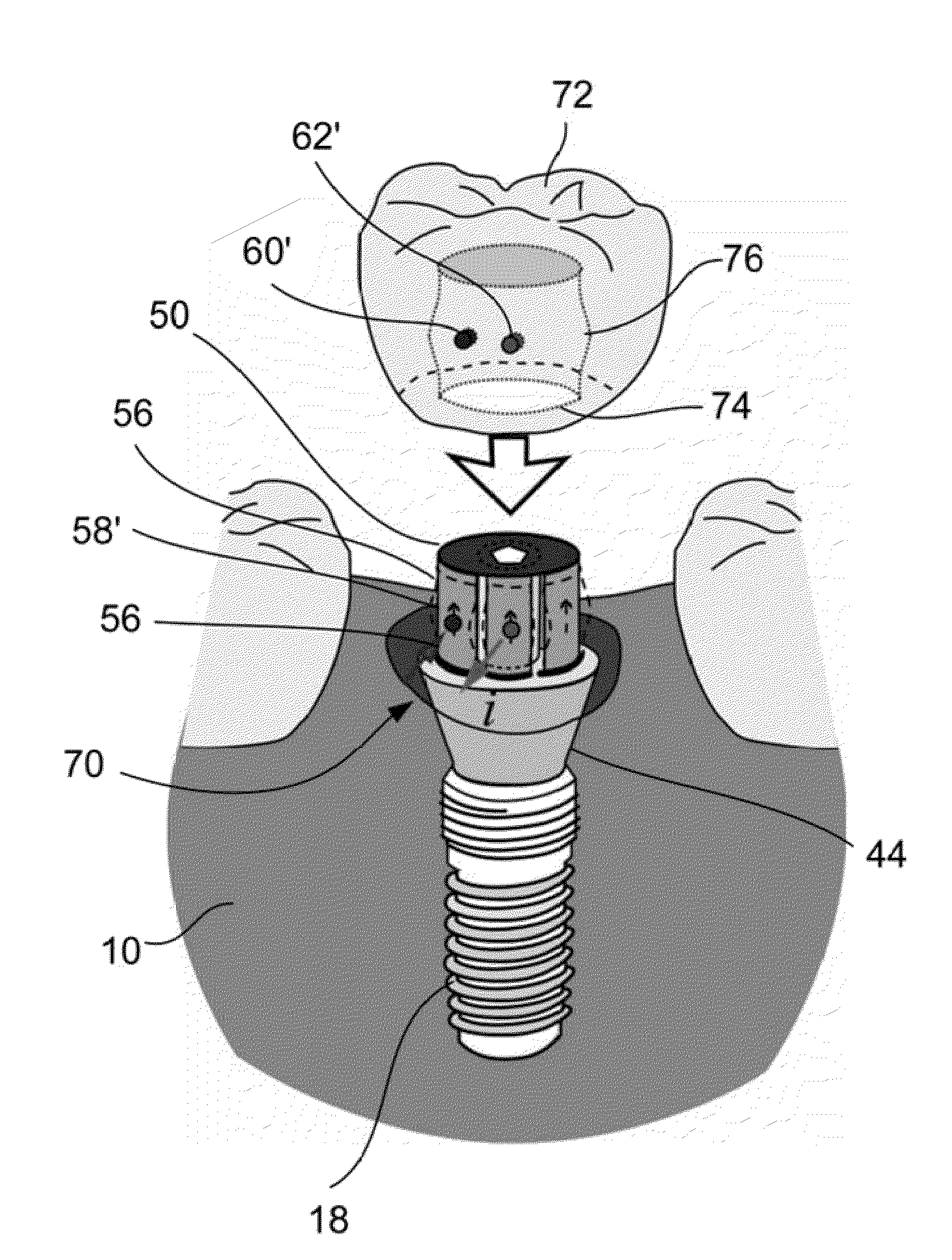 Dental rentention systems