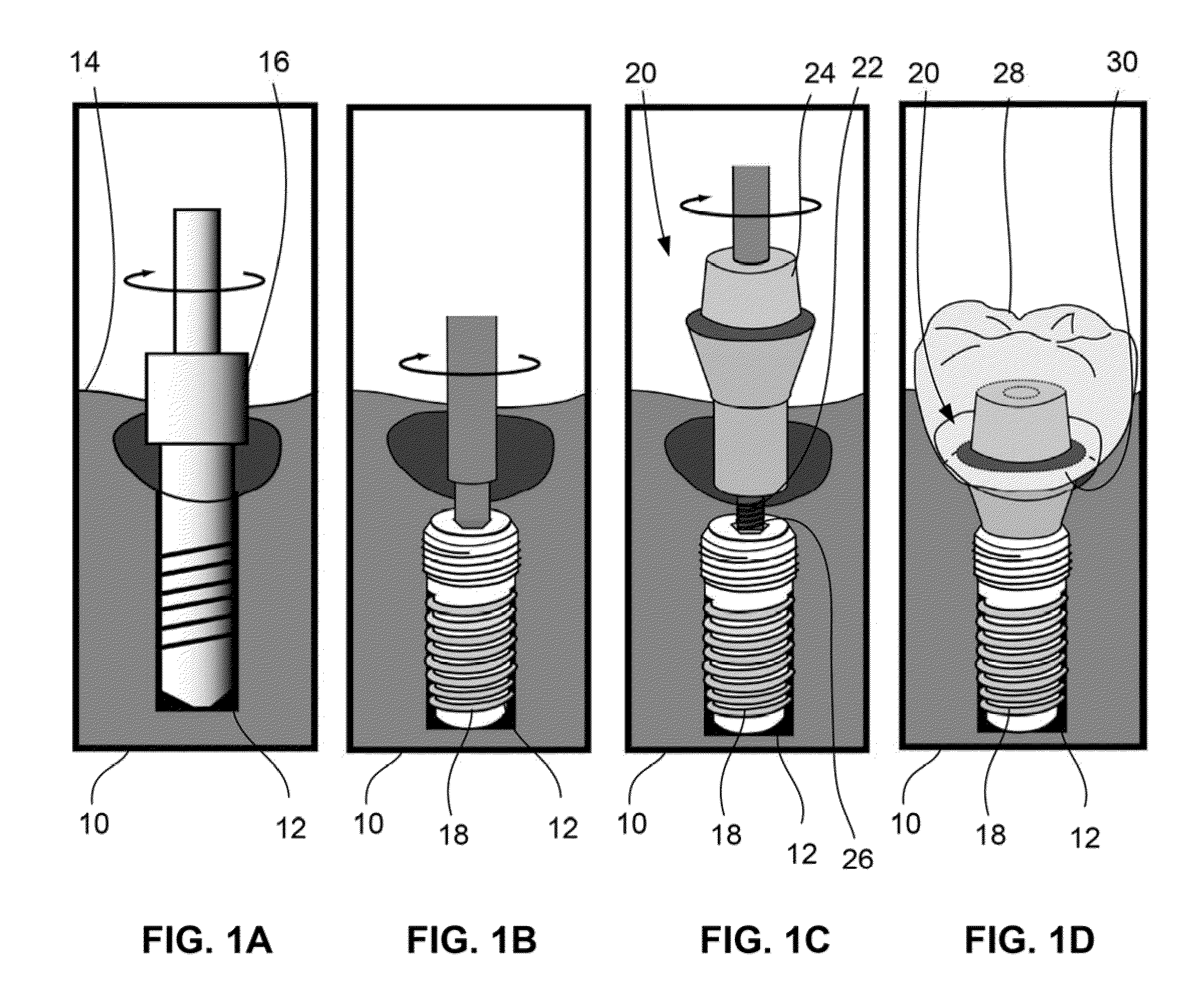 Dental rentention systems