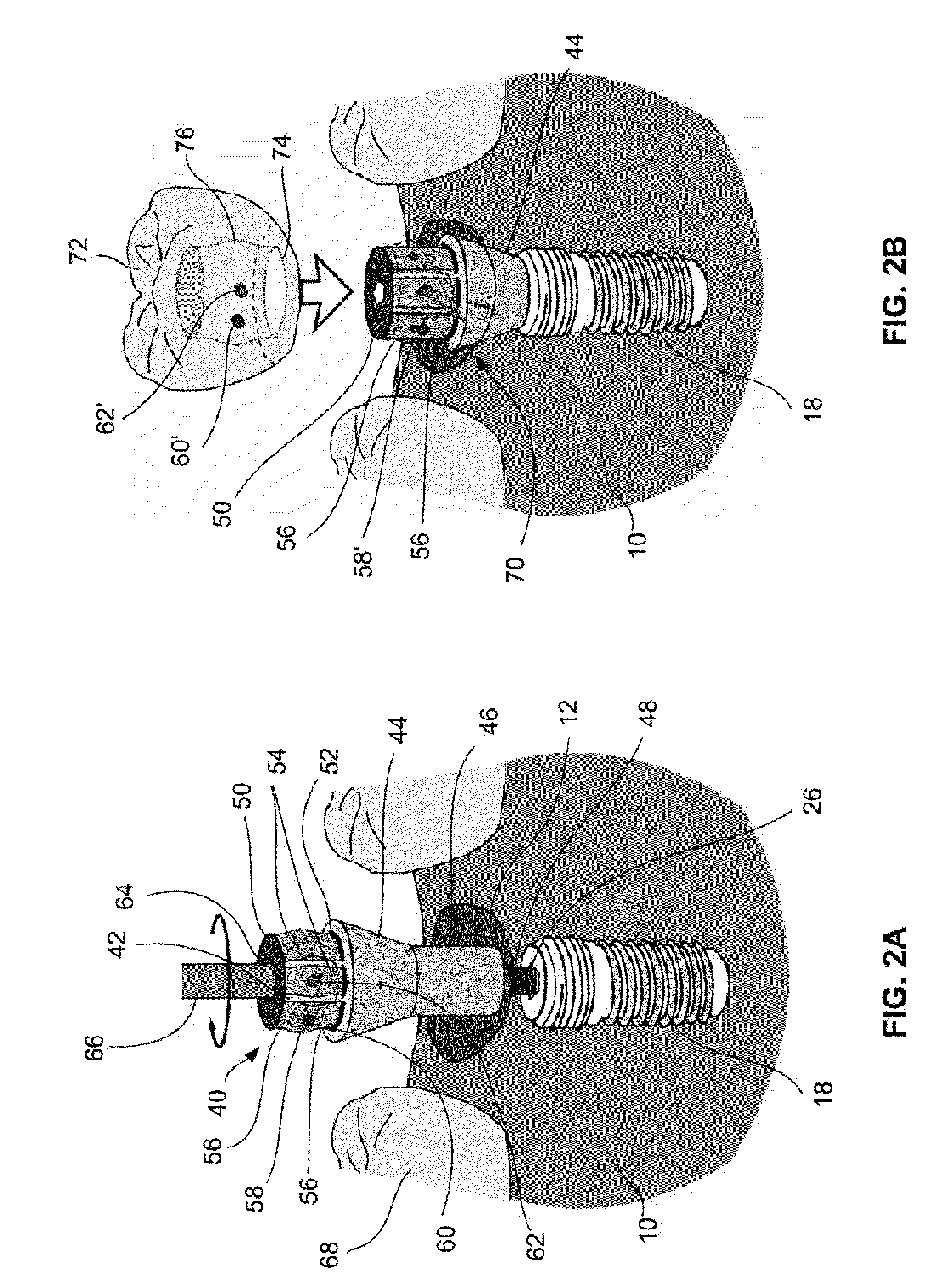 Dental rentention systems