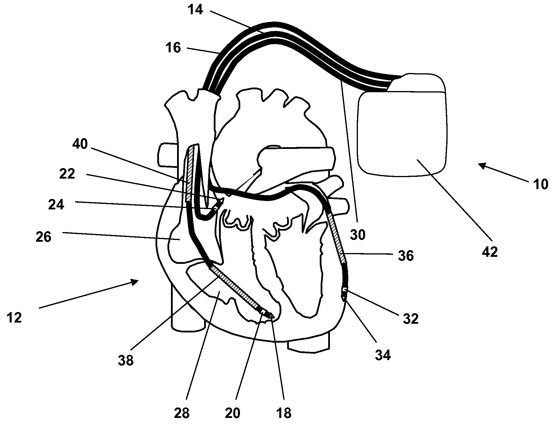 Electrotherapy device for treating tachycardiac arrhythmias of a heart