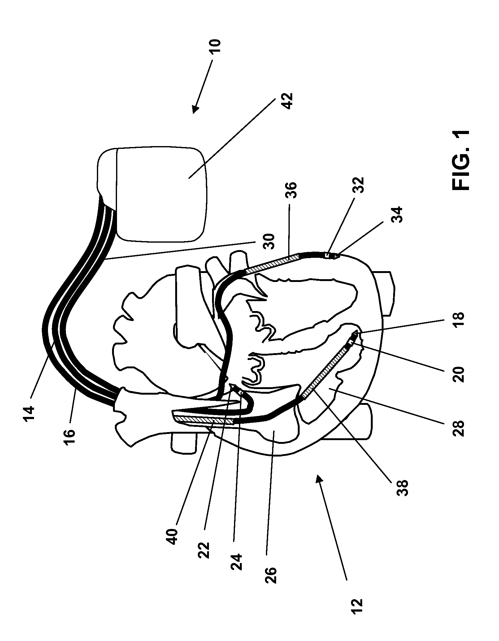 Electrotherapy device for treating tachycardiac arrhythmias of a heart