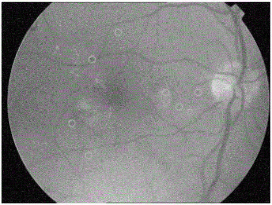 Classifier for micro-angioma of diabetes lesion based on colored image