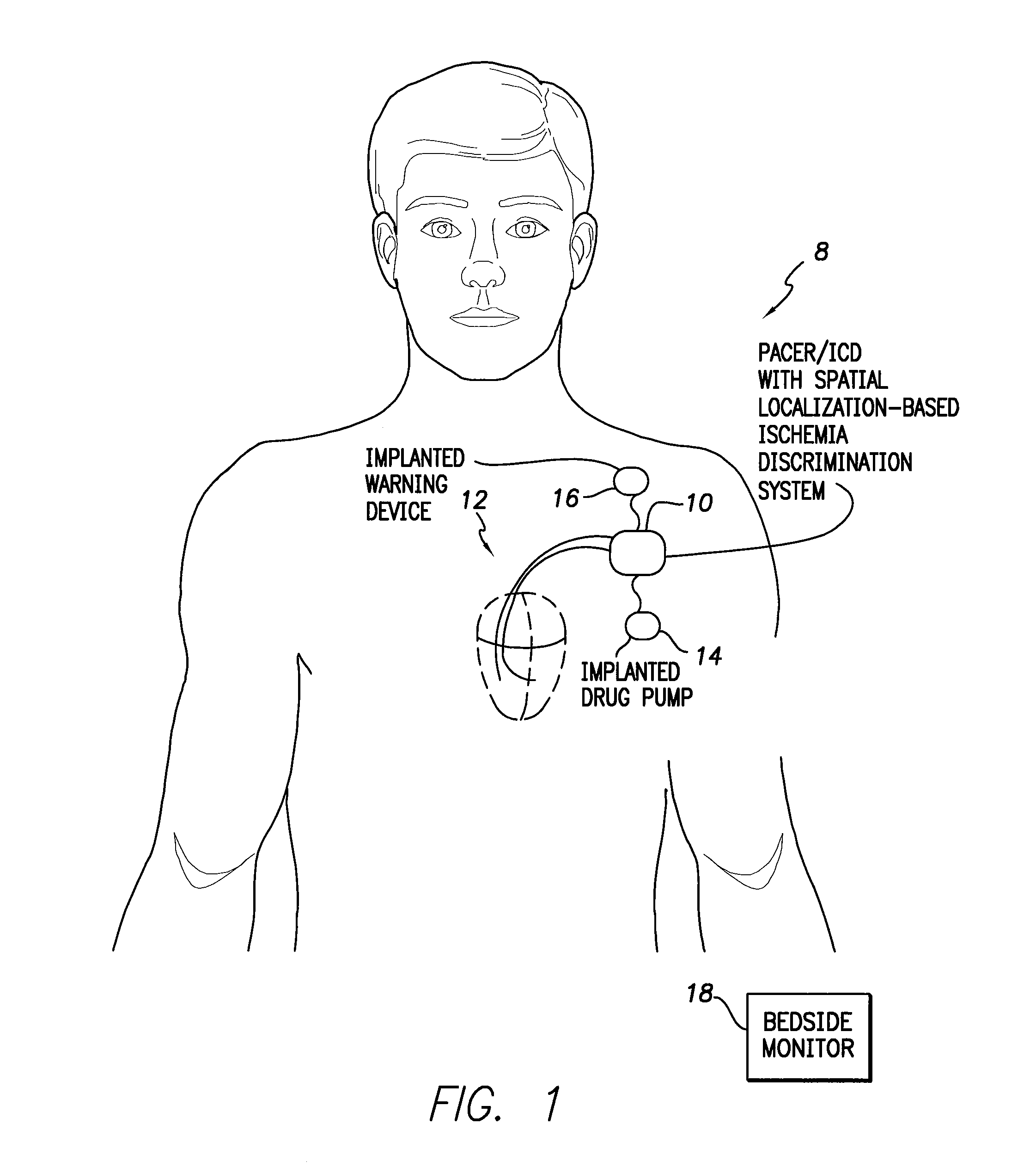 Systems and methods for distinguishing cardiac ischemia from systemic influences on IEGM morphology using an implantable medical device